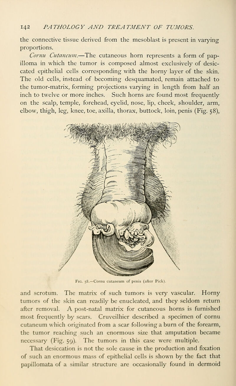 the connective tissue derived from the mesoblast is present in varying proportions. Cormi Cutaneum.—The cutaneous horn represents a form of pap- illoma in which the tumor is composed almost exclusively of desic- cated epithelial cells corresponding with the horny layer of the skin. The old cells, instead of becoming desquamated, remain attached to the tumor-matrix, forming projections varying in length from half an inch to twelve or more inches. Such horns are found most frequently on the scalp, temple, forehead, eyelid, nose, lip, cheek, shoulder, arm, elbow, thigh, leg, knee, toe, axilla, thorax, buttock, loin, penis (Fig. 58), Fig. 58.—Cornu cutaneum of penis (after Pick). and scrotum. The matrix of such tumors is very vascular. Horny tumors of the skin can readily be enucleated, and they seldom return after removal. A post-natal matrix for cutaneous horns is furnished most frequently by scars. Cruveilhier described a specimen of cornu cutaneum which originated from a scar following a burn of the forearm, the tumor reaching such an enormous size that amputation became necessary (Fig. 59). The tumors in this case were multiple. That desiccation is not the sole cause in the production and fixation of such an enormous mass of epithelial cells is shown by the fact that papillomata of a similar structure are occasionally found in dermoid