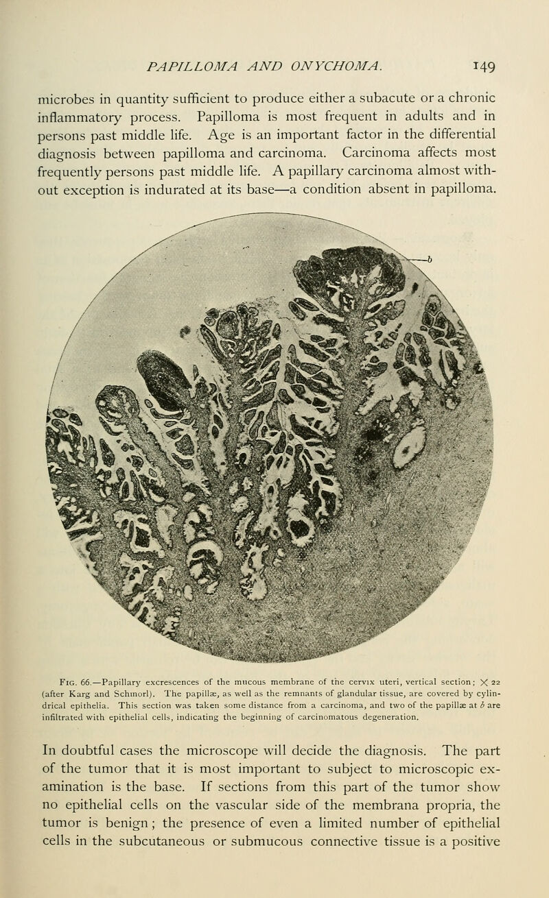 microbes in quantity sufficient to produce either a subacute or a chronic inflammatory process. Papilloma is most frequent in adults and in persons past middle life. Age is an important factor in the differential diagnosis between papilloma and carcinoma. Carcinoma affects most frequently persons past middle life. A papillary carcinoma almost with- out exception is indurated at its base—a condition absent in papilloma. *»^M?t.^w(av,rsij-i Fig. 66.^Papillary excrescences of the mucous membrane of the cervix uteri, vertical section; X 22 (after Karg and Schmorl). The papillae, as well as the remnants of glandular tissue, are covered by cylin- drical epithelia. This section was taken some distance from a carcinoma, and two of the papillae at b are infiltrated with epithelial cells, indicating the beginning of carcinomatous degeneration. In doubtful cases the microscope will decide the diagnosis. The part of the tumor that it is most important to subject to microscopic ex- amination is the base. If sections from this part of the tumor show no epithelial cells on the vascular side of the membrana propria, the tumor is benign; the presence of even a limited number of epithelial cells in the subcutaneous or submucous connective tissue is a positive