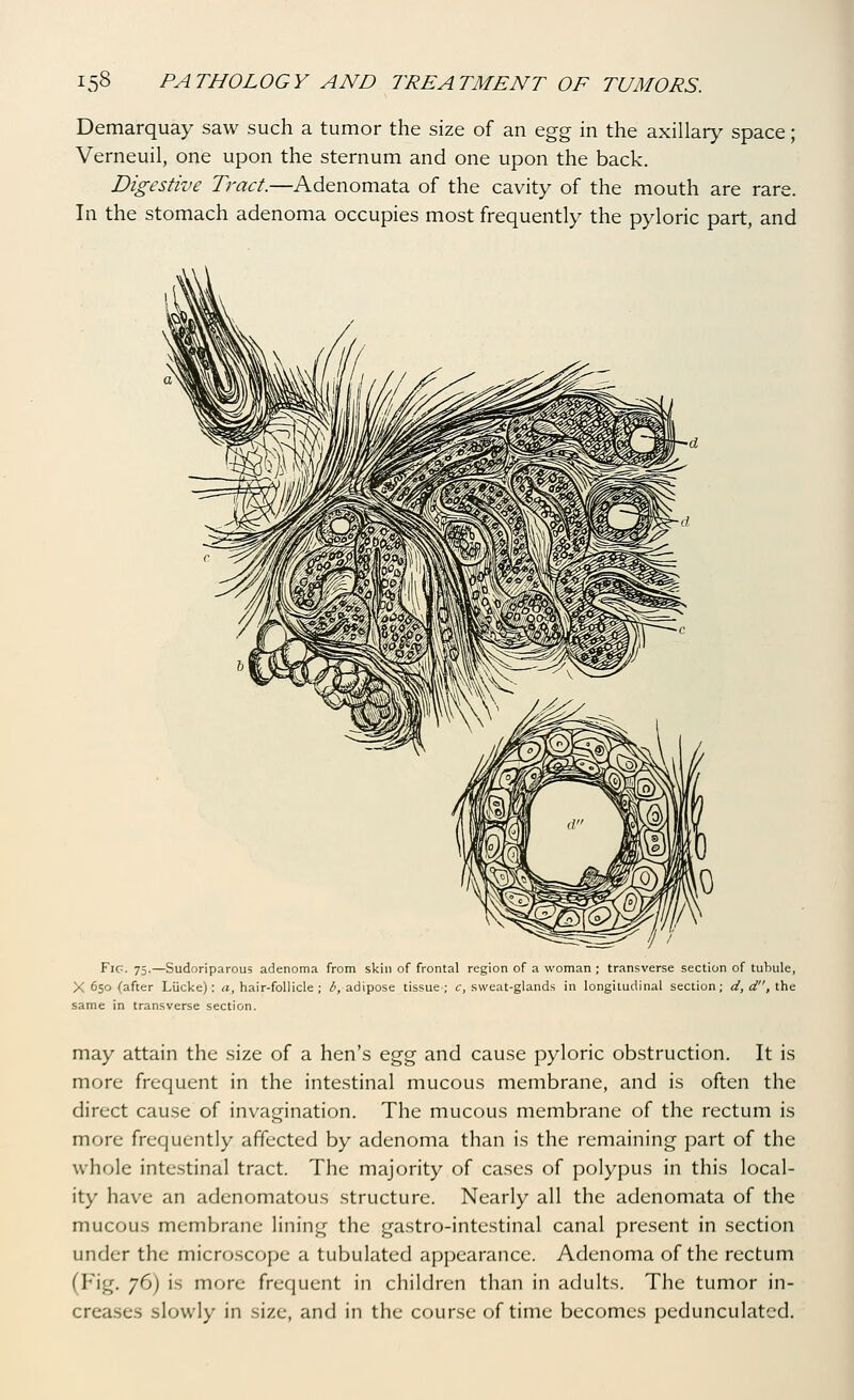 Demarquay saw such a tumor the size of an ^gg in the axillary space; Verneuil, one upon the sternum and one upon the back. Digestive Tract.—Adenomata of the cavity of the mouth are rare. In the stomach adenoma occupies most frequently the pyloric part, and FiP. 75.—Sudoriparous adenoma from skin of frontal region of a woman; transverse section of tubule, X 650 (after Liicke) : a, hair-follicle ; b, adipose tissue ; c, sweat-glands in longitudinal section; d, d, the same in transverse section. may attain the size of a hen's q^^ and cause pyloric obstruction. It is more frequent in the intestinal mucous membrane, and is often the direct cause of invagination. The mucous membrane of the rectum is more frequently affected by adenoma than is the remaining part of the whole intestinal tract. The majority of cases of polypus in this local- ity have an adenomatous structure. Nearly all the adenomata of the mucous membrane lining the gastro-intestinal canal present in section under the microscope a tubulated appearance. Adenoma of the rectum (Fig. 76) is more frequent in children than in adults. The tumor in- creases slowly in size, and in the course of time becomes pedunculated.