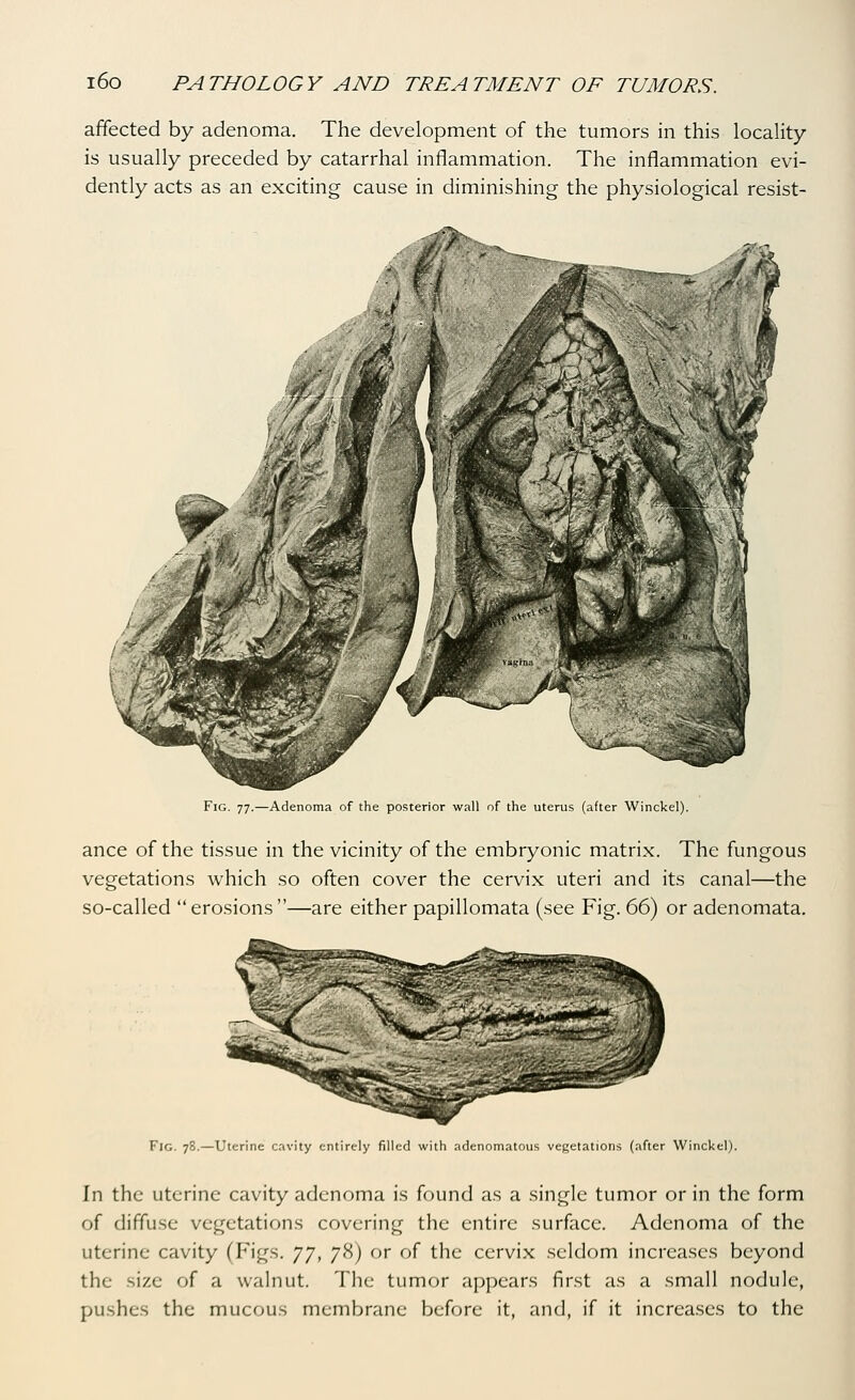 affected by adenoma. The development of the tumors in this locality is usually preceded by catarrhal inflammation. The inflammation evi- dently acts as an exciting cause in diminishing the physiological resist- Adenoma of the posterior wall of the uterus (after Winckel). ance of the tissue in the vicinity of the embryonic matrix. The fungous vegetations which so often cover the cervix uteri and its canal—the so-called erosions—are either papillomata (see Fig. 66) or adenomata. Fig. 78.—Uterine cavity entirely filled with adenomatous vegetations (after Winckel). In the uterine cavity adenoma is found as a single tumor or in the form of diffuse vegetations covering the entire surface. Adenoma of the uterine cavity (Figs, j'j, 78) or of the ccrvi.x seldom increases beyond the size of a walnut. The tumor appears first as a small nodule, pu.shes the mucous membrane before it, and, if it increases to the