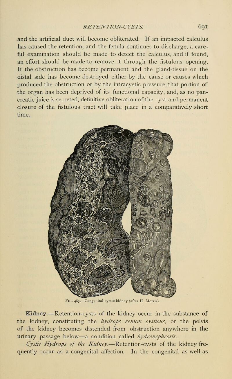 and the artificial duct will become obliterated. If an impacted calculus has caused the retention, and the fistula continues to discharge, a care- ful examination should be made to detect the calculus, and if found, an effort should be made to remove it through the fistulous opening. If the obstruction has become permanent and the gland-tissue on the distal side has become destroyed either by the cause or causes which produced the obstruction or by the intracystic pressure, that portion of the organ has been deprived of its functional capacity, and, as no pan- creatic juice is secreted, definitive obliteration of the cyst and permanent closure of the fistulous tract will take place in a comparatively short time. Fig. 483.—Conge: kidney (after H. Morris). Kidney.—Retention-cysts of the kidney occur in the substance of the kidney, constituting the liydrops renum cystiats, or the pelvis of the kidney becomes distended from obstruction anywhere in the urinary passage below—a condition called ]iydro7icphrosis. Cystic Hydrops of the Kidney.—Retention-cysts of the kidney fre- quently occur as a congenital affection. In the congenital as well as