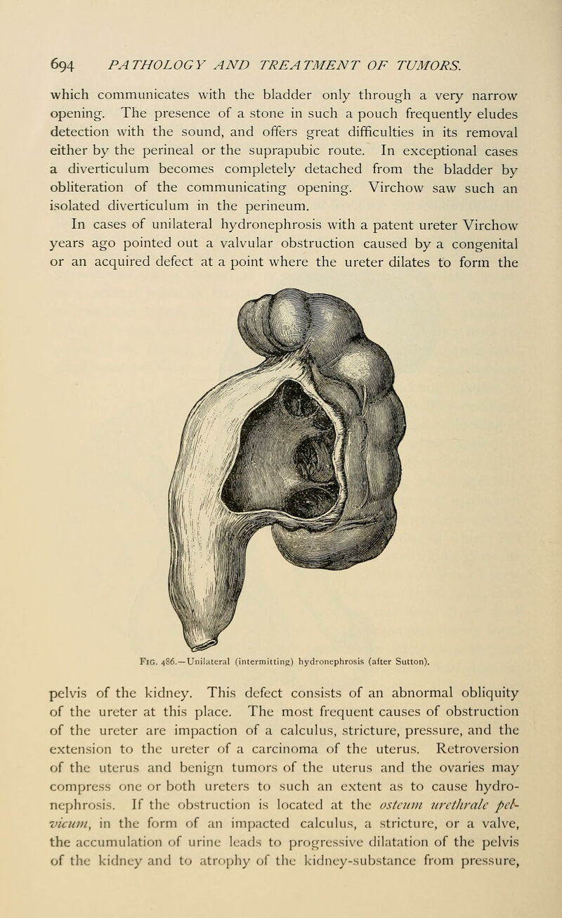 which communicates with the bladder only through a very narrow opening. The presence of a stone in such a pouch frequently eludes detection with the sound, and offers great difficulties in its removal either by the perineal or the suprapubic route. In exceptional cases a diverticulum becomes completely detached from the bladder by obliteration of the communicating opening. Virchow saw such an isolated diverticulum in the perineum. In cases of unilateral hydronephrosis with a patent ureter Virchow years ago pointed out a valvular obstruction caused by a congenital or an acquired defect at a point where the ureter dilates to form the Fig. 486.—Unilateral (intermitting) hydronephrosis (after Sutton), pelvis of the kidney. This defect consists of an abnormal obliquity of the ureter at this place. The most frequent causes of obstruction of the ureter are impaction of a calculus, stricture, pressure, and the extension to the ureter of a carcinoma of the uterus. Retroversion of the uterus and benign tumors of the uterus and the ovaries may compress one or both ureters to such an extent as to cause hydro- nephrosis. If the obstruction is located at the ostciun uretlirale peh- vicum, in the form of an impacted calculus, a stricture, or a valve, the accumulation of urine leads to progressive dilatation of the pelvis of the kidney and to atrophy of the kidney-substance from pressure.