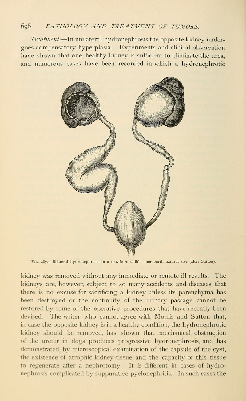 Treatvieiit.—In unilateral hydronephrosis the opposite kidney under- goes compensatory hyperplasia. Experiments and clinical observation have shown that one healthy kidney is sufficient to eliminate the urea, and numerous cases have been recorded in which a hydronephrotic Fig. 487.—Bilateral hydronephr -born child; one-fourth natural size (after Sutton). kidney was removed without any immediate or remote ill results. The kidneys are, however, subject to so many accidents and diseases that there is no excuse for sacrificing a kidney unless its parenchyma has been destroyed or the continuity of the urinaiy passage cannot be restored by some of the operative procedures that have recently been devised. The writer, who cannot agree with Morris and Sutton that, in ca.se the opposite kidney is in a healthy condition, the hydronephrotic kidney should be removed, has shown that mechanical obstruction of the ureter in dogs produces progressive hydronephrosis, and has demon.strated, by microscopical examination of the capsule of the cyst, the exi.stence of atrophic kidney-tissue and the capacity of this tissue to regenerate after a nephrotomy. It is different in cases of hydro- nephrosis complicated by suppurative pyelonephritis. In such cases the