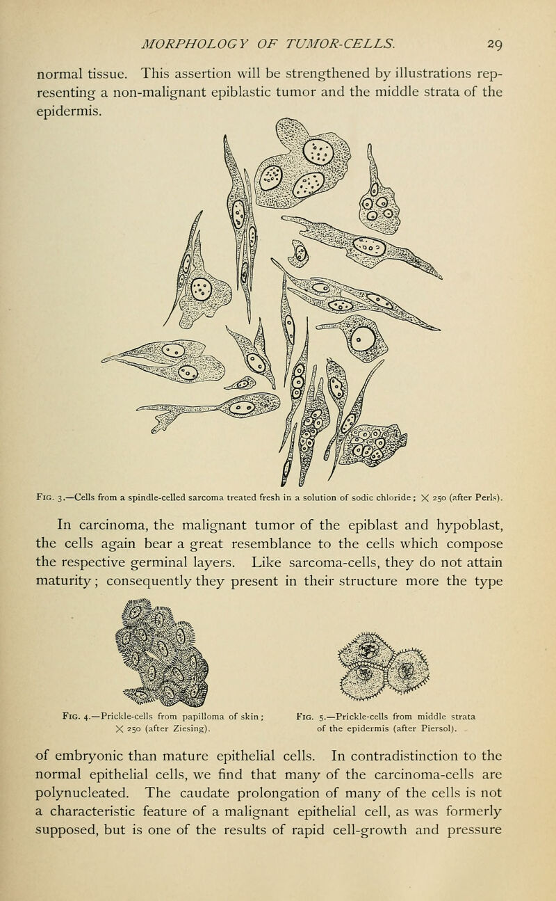 normal tissue. This assertion will be strengthened by illustrations rep- resenting a non-malignant epiblastic tumor and the middle strata of the epidermis. Fig. 3.—Cells from a spindle-celled sarcoma treated fresh in a solution of sodic chloride ; X 250 (after Perls). In carcinoma, the malignant tumor of the epiblast and hypoblast, the cells again bear a great resemblance to the cells which compose the respective germinal layers. Like sarcoma-cells, they do not attain maturity; consequently they present in their structure more the type Fig. 4.—Prickle-cells from papilloma of skin ; X 250 (after Ziesing). Fig. 5.—Prickle-cells from middle strata of the epidermis (after Piersol). of embryonic than mature epithelial cells. In contradistinction to the normal epithelial cells, we find that many of the carcinoma-cells are polynucleated. The caudate prolongation of many of the cells is not a characteristic feature of a malignant epithelial cell, as was formerly supposed, but is one of the results of rapid cell-growth and pressure