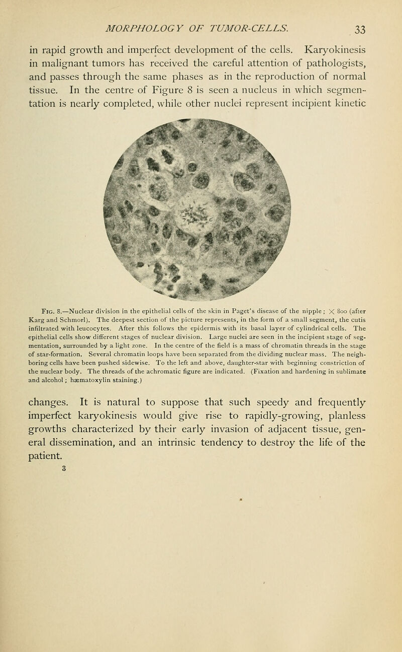in rapid growth and imperfect development of the cells. Karyokinesis in malignant tumors has received the careful attention of pathologists, and passes through the same phases as in the reproduction of normal tissue. In the centre of Figure 8 is seen a nucleus in which segmen- tation is nearly completed, while other nuclei represent incipient kinetic * ** ■■'&.. % ^Zd: Fig. 8.—Nuclear division in the epithelial cells of the skin in Paget's disease of the nipple ; X 8°° (after Karg and Schmorl). The deepest section of the picture represents, in the form of a small segment, the cutis infiltrated with leucocytes. After this follows the epidermis with its basal layer of cylindrical cells. The epithelial cells show different stages of nuclear division. Large nuclei are seen in the incipient stage of seg- mentation, surrounded by a light zone. In the centre of the field is a mass of chromatin threads in the stage of star-formation. Several chromatin loops have been separated from the dividing nuclear mass. The neigh- boring cells have been pushed sidewise. To the left and above, daughter-star with beginning constriction of the nuclear body. The threads of the achromatic figure are indicated. (Fixation and hardening in sublimate and alcohol; haematoxylin staining.) changes. It is natural to suppose that such speedy and frequently imperfect karyokinesis would give rise to rapidly-growing, planless growths characterized by their early invasion of adjacent tissue, gen- eral dissemination, and an intrinsic tendency to destroy the life of the patient. 3