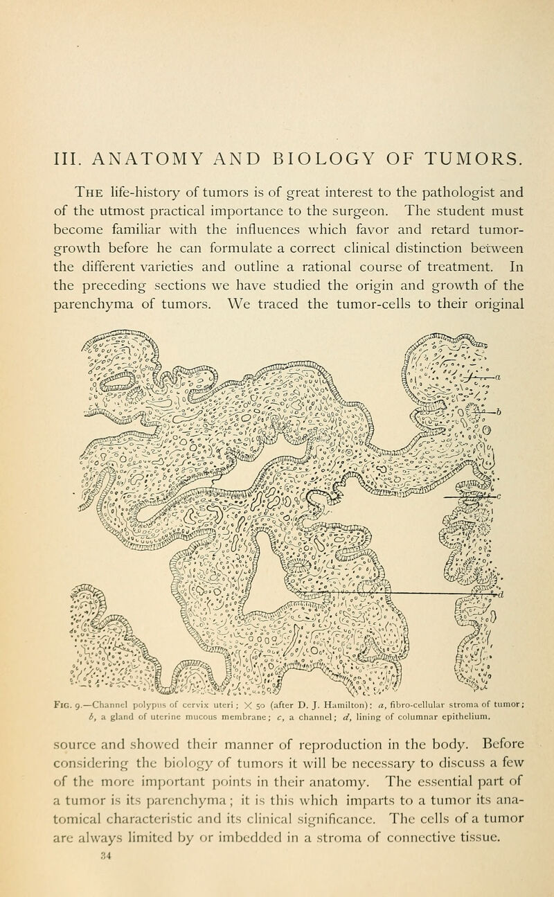 The life-history of tumors is of great interest to the pathologist and of the utmost practical importance to the surgeon. The student must become familiar with the influences which favor and retard tumor- growth before he can formulate a correct clinical distinction between the different varieties and outline a rational course of treatment. In the preceding sections we have studied the origin and growth of the parenchyma of tumors. We traced the tumor-cells to their original Fig. 9.—Channel polypus of cervix uteri ; X 5° (after D. J. Hamilton): a, fibro-cellular stroma of tumor; b, a gland of uterine mucous membrane; c, a channel; d, lining of columnar epithelium. source and showed their manner of reproduction in the body. Before considering the biology of tumors it will be necessary to discuss a few of the more important points in their anatomy. The essential part of a tumor is its parenchyma; it is this which imparts to a tumor its ana- tomical characteristic and its clinical significance. The cells of a tumor are always limited by or imbedded in a stroma of connective tissue.