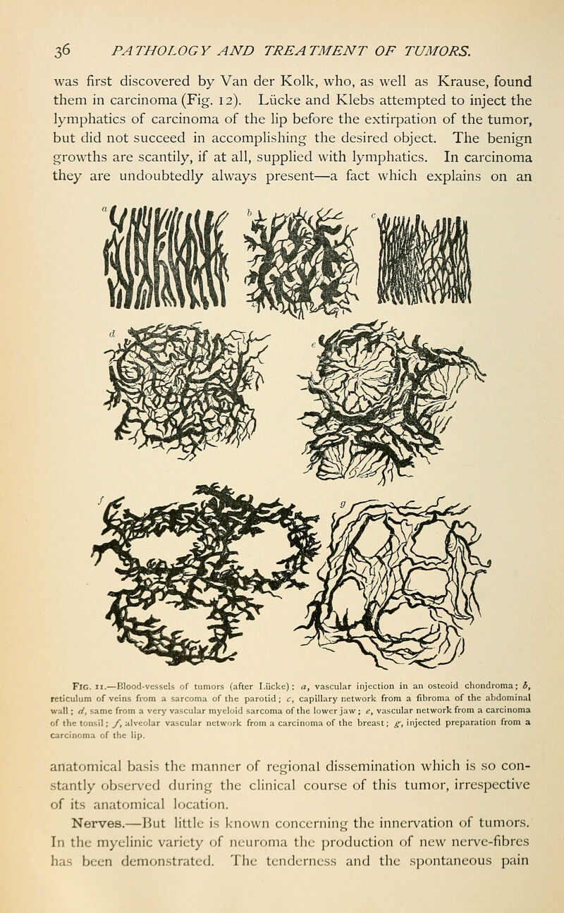 was first discovered by Van der Kolk, who, as well as Krause, found them in carcinoma (Fig. 12). Liicke and Klebs attempted to inject the lymphatics of carcinoma of the lip before the extirpation of the tumor, but did not succeed in accomplishing the desired object. The benign growths are scantily, if at all, supplied with lymphatics. In carcinoma they are undoubtedly always present—a fact which explains on an Fig. 11.—Blood-vessels of tumors (after Liicke): a, vascular injection in an osteoid chondroma; b, reticulum of veins from a sarcoma of the parotid; c, capillary network from a fibroma of the abdominal wall; d, same from a very vascular myeloid sarcoma of the lower jaw ; e, vascular network from a carcinoma of the tonsil; /, alveolar vascular network from a carcinoma of the breast; g, injected preparation from a carcinoma of the lip. anatomical basis the manner of regional dissemination which is so con- stantly observed during the clinical course of this tumor, irrespective of its anatomical location. Nerves.—But little is known concerning the innervation of tumors. In the myelinic variety of neuroma the production of new nerve-fibres has been demonstrated. The tenderness and the spontaneous pain