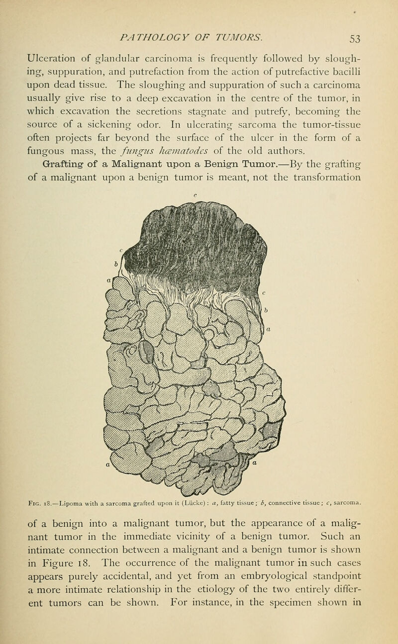 Ulceration of glandular carcinoma is frequently followed by slough- ing, suppuration, and putrefaction from the action of putrefactive bacilli upon dead tissue. The sloughing and suppuration of such a carcinoma usually give rise to a deep excavation in the centre of the tumor, in which excavation the secretions stagnate and putrefy, becoming the source of a sickening odor. In ulcerating sarcoma the tumor-tissue often projects far beyond the surface of the ulcer in the form of a fungous mass, the fungus hcematodes of the old authors. Grafting- of a Malignant upon a Benign Tumor.—By the grafting of a malignant upon a benign tumor is meant, not the transformation Fig. 18.—Lipoma with a sarcoma grafted upon it (Liicke) : a, fatty tissue; b, connective tissue ; c, sarcoma. of a benign into a malignant tumor, but the appearance of a malig- nant tumor in the immediate vicinity of a benign tumor. Such an intimate connection between a malignant and a benign tumor is shown in Figure 18. The occurrence of the malignant tumor in such cases appears purely accidental, and yet from an embryological standpoint a more intimate relationship in the etiology of the two entirely differ- ent tumors can be shown. For instance, in the specimen shown in