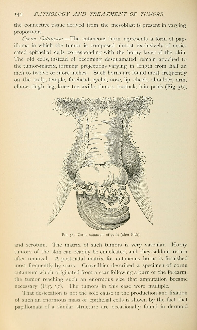 the connective tissue derived from the mesoblast is present in varying proportions. Cornu Cutaneum.—The cutaneous horn represents a form of pap- illoma in which the tumor is composed almost exclusively of desic- cated epithelial cells corresponding with the horny layer of the skin. The old cells, instead of becoming desquamated, remain attached to the tumor-matrix, forming projections vaiying in length from half an inch to twelve or more inches. Such horns are found most frequently on the scalp, temple, forehead, eyelid, nose, lip, cheek, shoulder, arm, elbow, thigh, leg, knee, toe, axilla, thorax, buttock, loin, penis (Fig. 56), Fig. 56.—Cornu cutaneum of penis (after Pick). and scrotum. The matrix of such tumors is very vascular. Horny tumors of the skin can readily be enucleated, and they seldom return after removal. A post-natal matrix for cutaneous horns is furnished most frequently by scars. Cruveilhier described a specimen of cornu cutaneum which originated from a scar following a burn of the forearm, the tumor reaching such an enormous size that amputation became necessary (Fig. 57). The tumors in this case were multiple. That desiccation is not the sole cause in the production and fixation of -uch an enormous mass of epithelial cells is shown by the fact that papillomata of a similar structure are occasionally found in dermoid