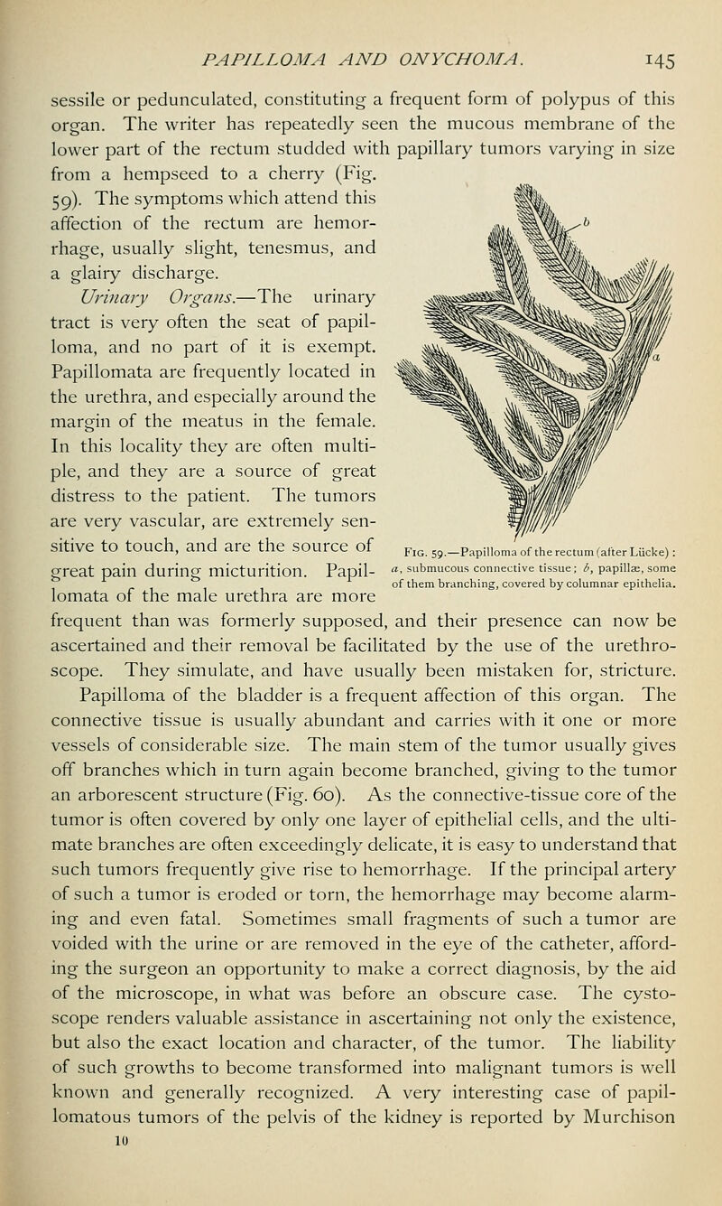 Fig. 59.—Papilloma of the rectum (after Liicke) : a, submucous connective tissue; b, papillae, some of them branching, covered by columnar epithelia. sessile or pedunculated, constituting a frequent form of polypus of this organ. The writer has repeatedly seen the mucous membrane of the lower part of the rectum studded with papillary tumors varying in size from a hempseed to a cherry (Fig. 59). The symptoms which attend this affection of the rectum are hemor- rhage, usually slight, tenesmus, and a glairy discharge. Urinary Organs.—The urinary tract is very often the seat of papil- loma, and no part of it is exempt. Papillomata are frequently located in the urethra, and especially around the margin of the meatus in the female. In this locality they are often multi- ple, and they are a source of great distress to the patient. The tumors are very vascular, are extremely sen- sitive to touch, and are the source of great pain during micturition. Papil- lomata of the male urethra are more frequent than was formerly supposed, and their presence can now be ascertained and their removal be facilitated by the use of the urethro- scope. They simulate, and have usually been mistaken for, stricture. Papilloma of the bladder is a frequent affection of this organ. The connective tissue is usually abundant and carries with it one or more vessels of considerable size. The main stem of the tumor usually gives off branches which in turn again become branched, giving to the tumor an arborescent structure (Fig. 60). As the connective-tissue core of the tumor is often covered by only one layer of epithelial cells, and the ulti- mate branches are often exceedingly delicate, it is easy to understand that such tumors frequently give rise to hemorrhage. If the principal artery of such a tumor is eroded or torn, the hemorrhage may become alarm- ing and even fatal. Sometimes small fragments of such a tumor are voided with the urine or are removed in the eye of the catheter, afford- ing the surgeon an opportunity to make a correct diagnosis, by the aid of the microscope, in what was before an obscure case. The cysto- scope renders valuable assistance in ascertaining not only the existence, but also the exact location and character, of the tumor. The liability of such growths to become transformed into malignant tumors is well known and generally recognized. A very interesting case of papil- lomatous tumors of the pelvis of the kidney is reported by Murchison 10