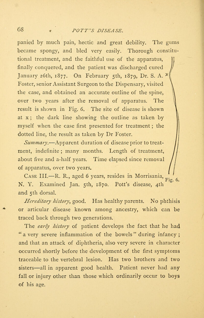 6S panied by much pain, hectic and great debiHty. The gums became spongy, and bled very easily. Thorough constitu- tional treatment, and the faithful use of the apparatus, finally conquered, and the patient was discharged cured January 26th, 1877. On February 5th, 1879, ^^- S- A. -^i Foster, senior Assistant Surgeon to the Dispensary, visited the case, and obtained an accurate outline of the spine, over two years after the removal of apparatus. The result is shown in Fig. 6. The site of disease is shown at X ; the dark line showing the outline as taken by myself when the case first presented for treatment; the dotted line, the result as taken by Dr Foster. Siwimary.—Apparent duration of disease prior to treat- ment, indefinite ; many months. Length of treatment, about five and a-half years. Time elapsed since removal of apparatus, over two years. Case III.—R. R., aged 6 years, resides in Morrisania, N. Y. Examined Jan. 5th, 1870. Pott's disease, 4th Hej-editary history^ good. Has healthy parents. No phthisis or articular disease known among ancestry, which can be traced back through two generations. The eai'ly history of patient develops the fact that he had  a very severe inflammation of the bowels  during infancy ; and that an attack of diphtheria, also very severe in character occurred shortly before the development of the first symptoms traceable to the vertebral lesion. Has two brothers and two sisters—all in apparent good health. Patient never had any fall or injury other than those which ordinarily occur to boys of his age. Fig. 6.