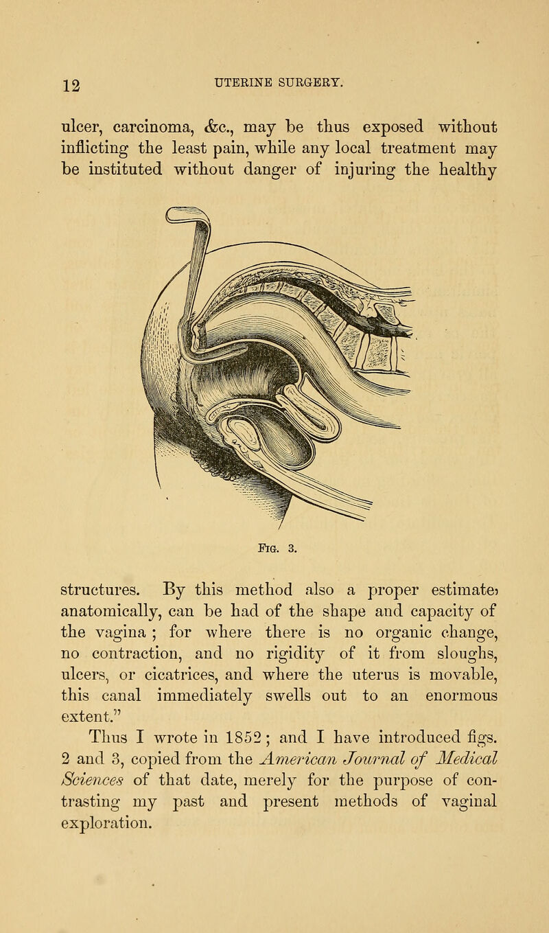 ulcer, carcinoma, <fcc, may be thus exposed without inflicting the least pain, while any local treatment may be instituted without danger of injuring the healthy Fig. 3. structures. By this method also a proper estimate? anatomically, can be had of the shape and capacity of the vagina ; for where there is no organic change, no contraction, and no rigidity of it from sloughs, ulcers, or cicatrices, and where the uterus is movable, this canal immediately swells out to an enormous extent. Thus I wrote in 1852; and I have introduced figs. 2 and 3, copied from the American Journal of Medical Sciences of that date, merely for the purpose of con- trasting my past and present methods of vaginal exploration.