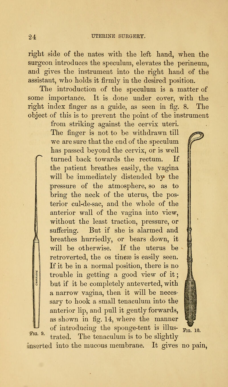 u right side of the nates with the left hand, when the surgeon introduces the speculum, elevates the perineum, and gives the instrument into the right hand of the assistant, who holds it firmly in the desired position. The introduction of the speculum is a matter of some importance. It is done under cover, with the right index finger as a guide, as seen in fig. 8. The object of this is to prevent the point of the instrument from striking against the cervix uteri. The finger is not to be withdrawn till we are sure that the end of the speculum has passed beyond the cervix, or is well turned back towards the rectum. If the patient breathes easily, the vagina will be immediately distended by the pressure of the atmosphere, so as to bring the neck of the uterus, the pos- terior cul-de-sac, and the whole of the anterior wall of the vagina into view, without the least traction, pressure, or suffering. But if she is alarmed and breathes hurriedly, or bears down, it will be otherwise. If the uterus be retroverted, the os tinese is easily seen. If it be in a normal position, there is no trouble in getting a good view of it; but if it be completely anteverted, with a narrow vagina, then it will be neces- sary to hook a small tenaculum into the anterior lip, and pull it gently forwards, as shown in fig. 14, where the manner of introducing the sponge-tent is illus- i^T10# ' trated. The tenaculum is to be slightly ■inserted into the mucous membrane. It gives no pain,