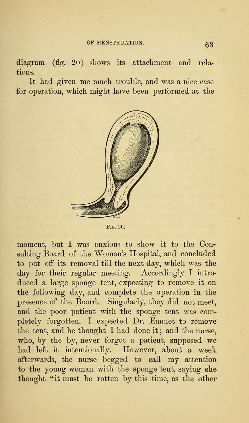 diagram (fig. 20) shows its attachment and rela- tions. It had given me much trouble, and was a nice case for operation, which might have been performed at the Fig. 20. moment, but I was anxious to show it to the Con- sulting Board of the Woman's Hospital, and concluded to put off its removal till the next day, which was the day for their regular meeting. Accordingly I intro- duced a large sponge tent, expecting to remove it on the following day, and complete the operation in the presence of the Board. Singularly, they did not meet, and the poor patient with the sponge tent was com- pletely forgotten. I expected Dr. Emmet to remove the tent, and he thought I had done it; and the nurse, who, by the by, never forgot a patient, supposed we had left it intentionally. However, about a week afterwards, the nurse begged to call my attention to the young woman with the sponge tent, saying she thought it must be rotten by this time, as the other