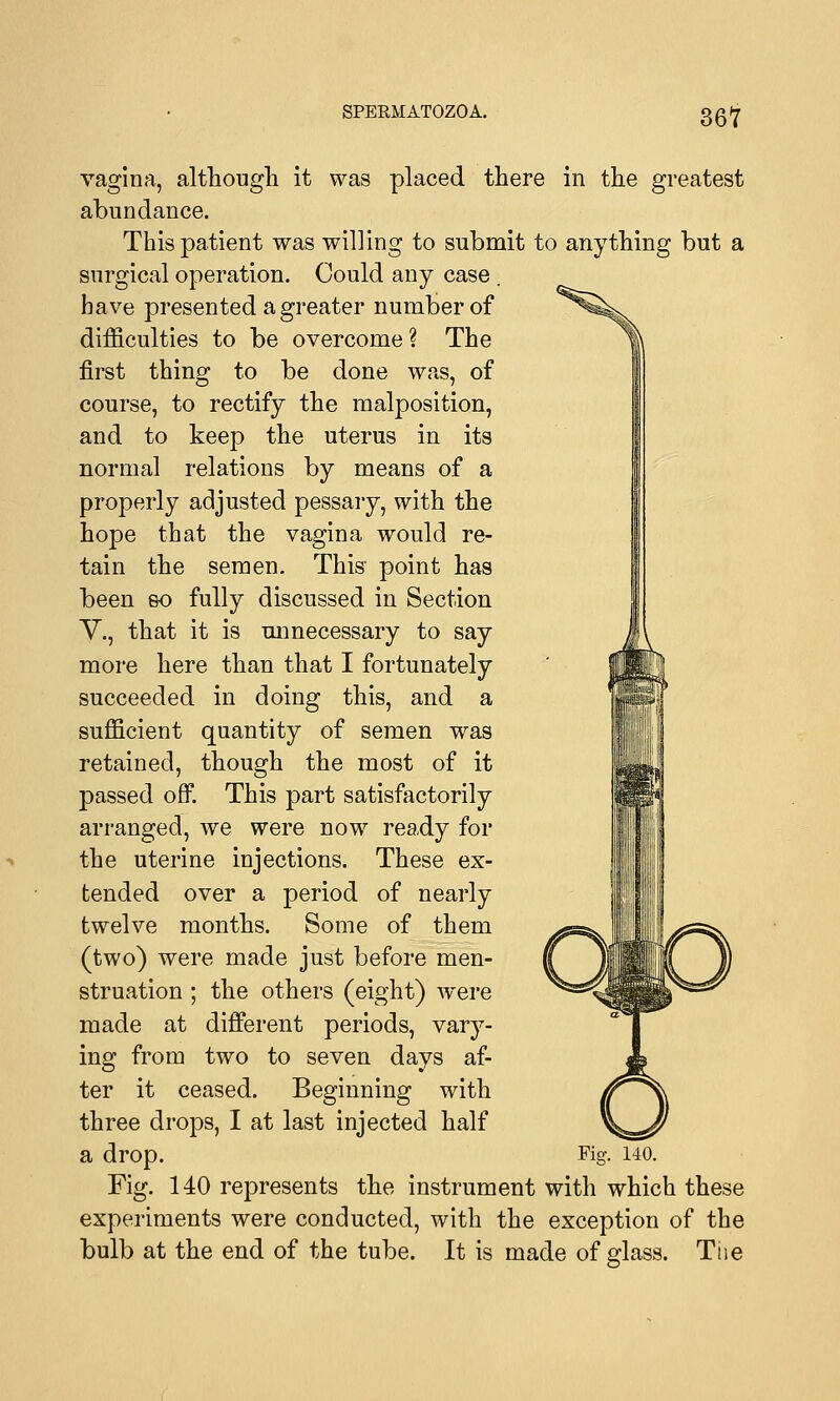 vagina, although it was placed there in the greatest abundance. This patient was willing to submit to anything but a surgical operation. Could any case . have presented a greater number of difficulties to be overcome? The first thing to be done was, of course, to rectify the malposition, and to keep the uterus in its normal relations by means of a properly adjusted pessary, with the hope that the vagina would re- tain the semen. This point has been so fully discussed in Section V., that it is unnecessary to say more here than that I fortunately succeeded in doing this, and a sufficient quantity of semen was retained, though the most of it passed off. This part satisfactorily arranged, we were now ready for the uterine injections. These ex- tended over a period of nearly twelve months. Some of them (two) were made just before men- struation ; the others (eight) were made at different periods, vary- ing from two to seven days af- ter it ceased. Beginning with three drops, I at last injected half a drop. Fig. 140. Fig. 140 represents the instrument with which these experiments were conducted, with the exception of the bulb at the end of the tube. It is made of glass. Tiie