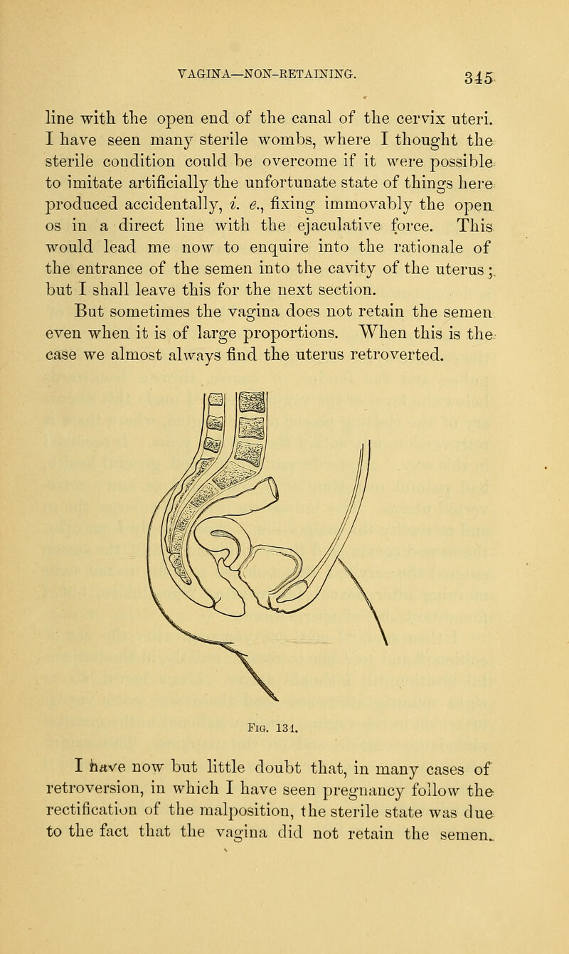 VAGINA—NON-RETAINING. line with the open end of the canal of the cervix uteri. I have seen many sterile wombs, where I thought the sterile condition could be overcome if it were possible to imitate artificially the unfortunate state of things here produced accidentally, i. e., fixing immovably the open os in a direct line with the ejaculative force. This would lead me now to enquire into the rationale of the entrance of the semen into the cavity of the uterus;, but I shall leave this for the next section. But sometimes the vagina does not retain the semen even when it is of large proportions. When this is the case we almost always find the uterus retroverted. Fig. 131. I have now but little doubt that, in many cases of retroversion, in which I have seen pregnancy follow the rectification of the malposition, the sterile state was due to the fact that the vagina did not retain the semen..