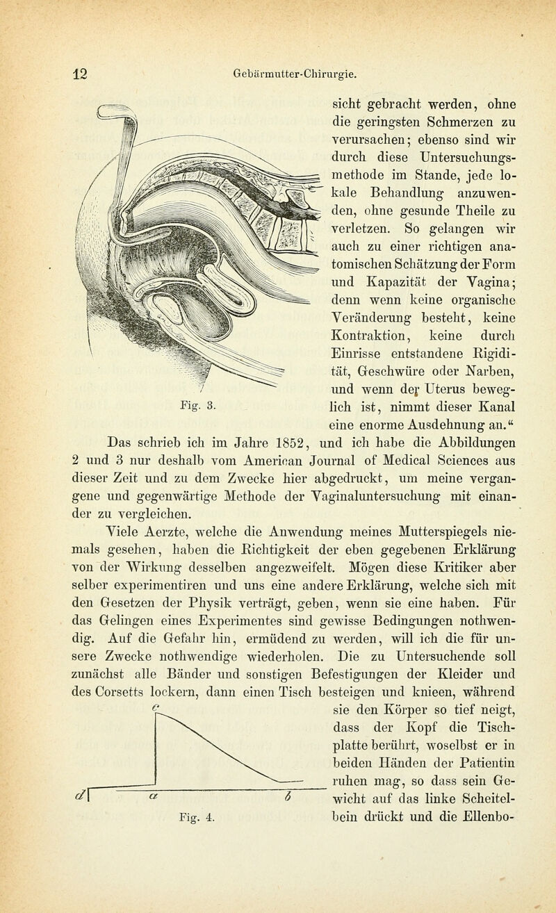 Fig. 3. sieht gebracht werden, ohne die geringsten Schmerzen zu verursachen; ebenso sind wir durch diese Untersuchungs- methode im Stande, jede lo- kale Behandlung anzuwen- den, ohne gesunde Theile zu verletzen. So gelangen wir auch zu einer richtigen ana- tomischen Schätzung der Form und Kapazität der Vagina; denn wenn keine organische Veränderung besteht, keine Kontraktion, keine durch Einrisse entstandene Rigidi- tät, Geschwüre oder Narben, und wenn def Uterus beweg- lich ist, nimmt dieser Kanal eine enorme Ausdehnung an. Das schrieb ich im Jahre 1852, und ich habe die Abbildungen 2 und 3 nur deshalb vom American Journal of Medical Sciences aus dieser Zeit und zu dem Zwecke hier abgedruckt, um meine vergan- gene und gegenwärtige Methode der Vaginaluntersuchung mit einan- der zu vergleichen. Viele Aerzte, welche die Anwendung meines Mutterspiegels nie- mals gesehen, haben die Eichtigkeit der eben gegebenen Erklärung von der Wirkung desselben angezweifelt. Mögen diese Kritiker aber selber experimentiren und uns eine andere Erklärung, welche sich mit den Gesetzen der Physik verträgt, geben, wenn sie eine haben. Für das Gelingen eines Experimentes sind gewisse Bedingungen nothwen- dig. Auf die Gefahr hin, ermüdend zu werden, will ich die für un- sere Zwecke nothwendige wiederholen. Die zu Untersuchende soll zunächst alle Bänder und sonstigen Befestigungen der Kleider und des Corsetts lockern, dann einen Tisch besteigen und knieen, während sie den Körper so tief neigt, dass der Kopf die Tisch- platte berührt, woselbst er in beiden Händen der Patientin ruhen mag, so dass sein Ge- wicht auf das linke Scheitel- Fig. 4. bein drückt und die Ellenbo-