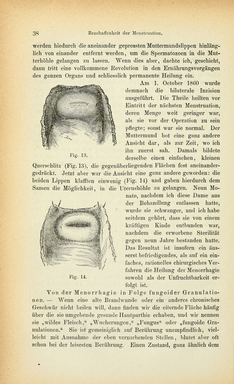 werden hiedurch die aneinander gepressten Muttermundslippen hinläng- lich von einander entfernt werden, um die Spermatozoen in die Mut- terhöhle gelangen zu lassen. Wenn dies aber, dachte ich, geschieht, dann tritt eine vollkommene Revolution in den Ernährungsvorgängen des ganzen Organs und schliesslich permanente Heilung ein. Am 1. Octoher 1860 wurde demnach die bilaterale Inzision ausgeführt. Die Theile heilten vor Eintritt der nächsten Menstruation, deren Menge weit geringer war, als sie vor der Operation zu sein pflegte; sonst war sie normal. Der Muttermund bot eine ganz andere Ansicht dar, als zur Zeit, wo ich ihn zuerst sah. Damals bildete derselbe einen einfachen, kleinen Querschlitz (Fig. 13), die gegenüberliegenden Flächen fest aneinander- gedrückt. Jetzt aber war die Ansicht eine ganz andere geworden: die beiden Lippen klafften einwenig (Fig. 14) und gaben hierdurch dem Samen die Möglichkeit, in die Uterushöhle zu gelangen. Neun Mo- nate, nachdem ich diese Dame aus der Behandlung entlassen hatte, wurde sie schwanger, und ich habe seitdem gehört, dass sie von einem kräftigen Kinde entbunden war, nachdem die erworbene Sterilität gegen neun Jahre bestanden hatte. Das Resultat ist insofern ein äus- serst befriedigendes, als auf ein ein- faches, rationelles chirurgisches Ver- fahren die Heilung der Menorrhagie sowohl als der Unfruchtbarkeit er- folgt ist. Yon der Menorrhagie in Folge fungoider Granulatio- nen. — Wenn eine alte Brandwunde oder ein- anderes chronisches Geschwür nicht heilen will, dann finden wir die eiternde Fläche häufig über die sie umgebende gesunde Hautparthie erhaben, und wir nennen sie „wildes Fleisch, „Wucherungen, „Fungus oder „fungoide Gra- nulationen. Sie ist gemeiniglich auf Berührung unempfindlich, viel- leicht mit Ausnahme der eben vernarbenden Stellen, blutet aber oft schon bei der leisesten Berührung. Einen Zustand, ganz ähnlich dem Fig. 14.