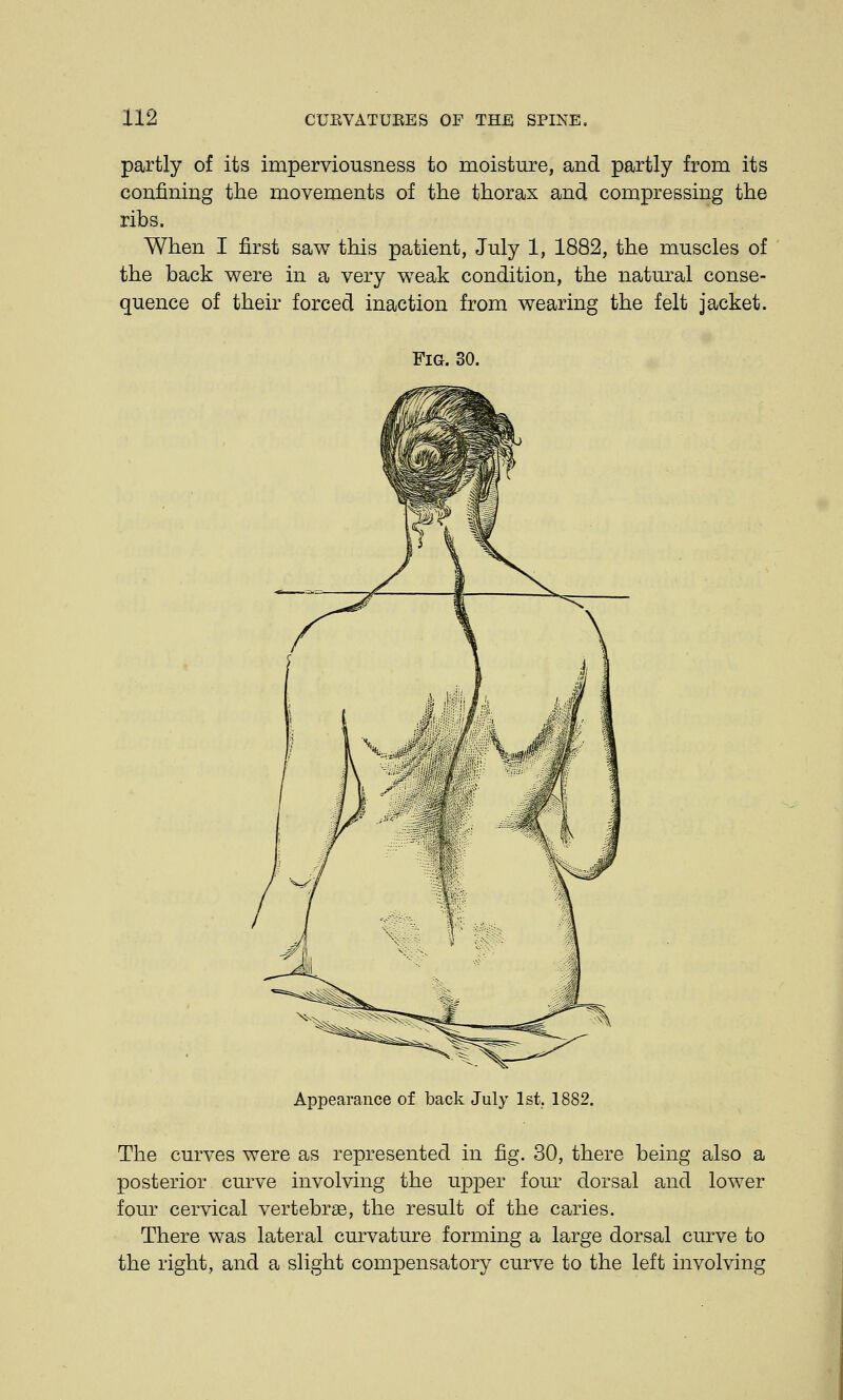 partly of its iraperviousness to moisture, and partly from its confining the movements of the thorax and compressing the ribs. When I first saw this patient, July 1, 1882, the muscles of the back were in a very weak condition, the natural conse- quence of their forced inaction from wearing the felt jacket. Fig. 30. Appearance of back July 1st, 1882. The curves were as represented in fig. 30, there being also a posterior curve involving the upper four dorsal and lower four cervical vertebrae, the result of the caries. There was lateral curvature forming a large dorsal curve to the right, and a slight compensatory curve to the left involving