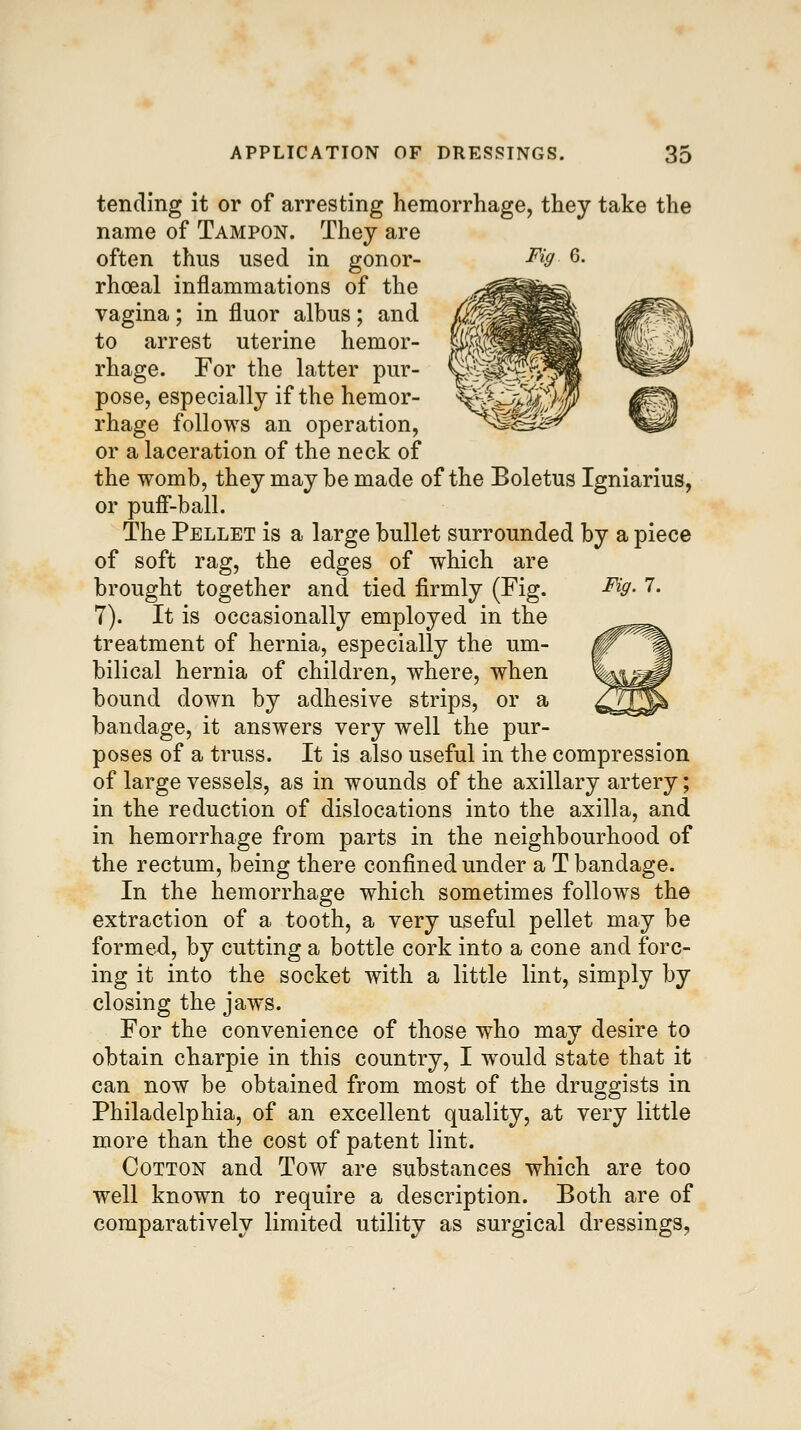 Fig 6. Fig.l. tending it or of arresting hemorrhage, they take the name of Tampon. They are often thus used in gonor- rhoea! inflammations of the vagina; in fluor albus; and to arrest uterine hemor- rhage. For the latter pur- pose, especially if the hemor- rhage follows an operation, or a laceration of the neck of the womb, they may be made of the Boletus Igniarius, or pufi'-ball. The Pellet is a large bullet surrounded by a piece of soft rag, the edges of which are brought together and tied firmly (Fig. 7). It is occasionally employed in the treatment of hernia, especially the um- bilical hernia of children, where, when bound down by adhesive strips, or a bandage, it answers very well the pur- poses of a truss. It is also useful in the compression of large vessels, as in wounds of the axillary artery; in the reduction of dislocations into the axilla, and in hemorrhage from parts in the neighbourhood of the rectum, being there confined under a T bandage. In the hemorrhage which sometimes follows the extraction of a tooth, a very useful pellet may be formed, by cutting a bottle cork into a cone and forc- ing it into the socket with a little lint, simply by closing the jaws. For the convenience of those who may desire to obtain charpie in this country, I would state that it can now be obtained from most of the druggists in Philadelphia, of an excellent quality, at very little more than the cost of patent lint. Cotton and Tow are substances which are too well known to require a description. Both are of comparatively limited utility as surgical dressings.