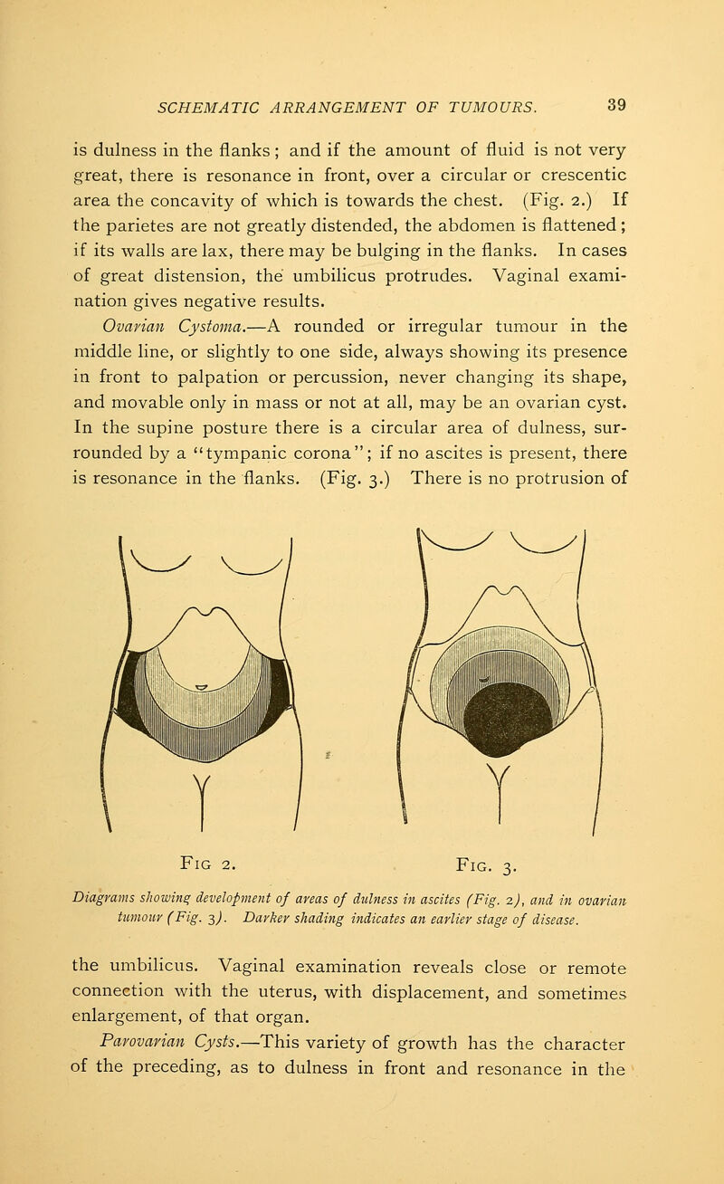 is dulness in the flanks ; and if the amount of fluid is not very- great, there is resonance in front, over a circular or crescentic area the concavity of which is towards the chest, (Fig. 2.) If the parietes are not greatly distended, the abdomen is flattened; if its walls are lax, there may be bulging in the flanks. In cases of great distension, the umbilicus protrudes. Vaginal exami- nation gives negative results. Ovarian Cystoma.—A rounded or irregular tumour in the middle line, or slightly to one side, always showing its presence in front to palpation or percussion, never changing its shape, and movable only in mass or not at all, may be an ovarian cyst. In the supine posture there is a circular area of dulness, sur- rounded by a tympanic corona; if no ascites is present, there is resonance in the flanks. (Fig. 3.) There is no protrusion of Fig 2. Fig. 3. Diagrams showinq development of areas of dulness in ascites (Fig. 2), and in ovarian tumour (Fig. ^). Darker shading indicates an earlier stage of disease. the umbilicus. Vaginal examination reveals close or remote connection with the uterus, with displacement, and sometimes enlargement, of that organ. Parovarian Cysts.—This variety of growth has the character of the preceding, as to dulness in front and resonance in the