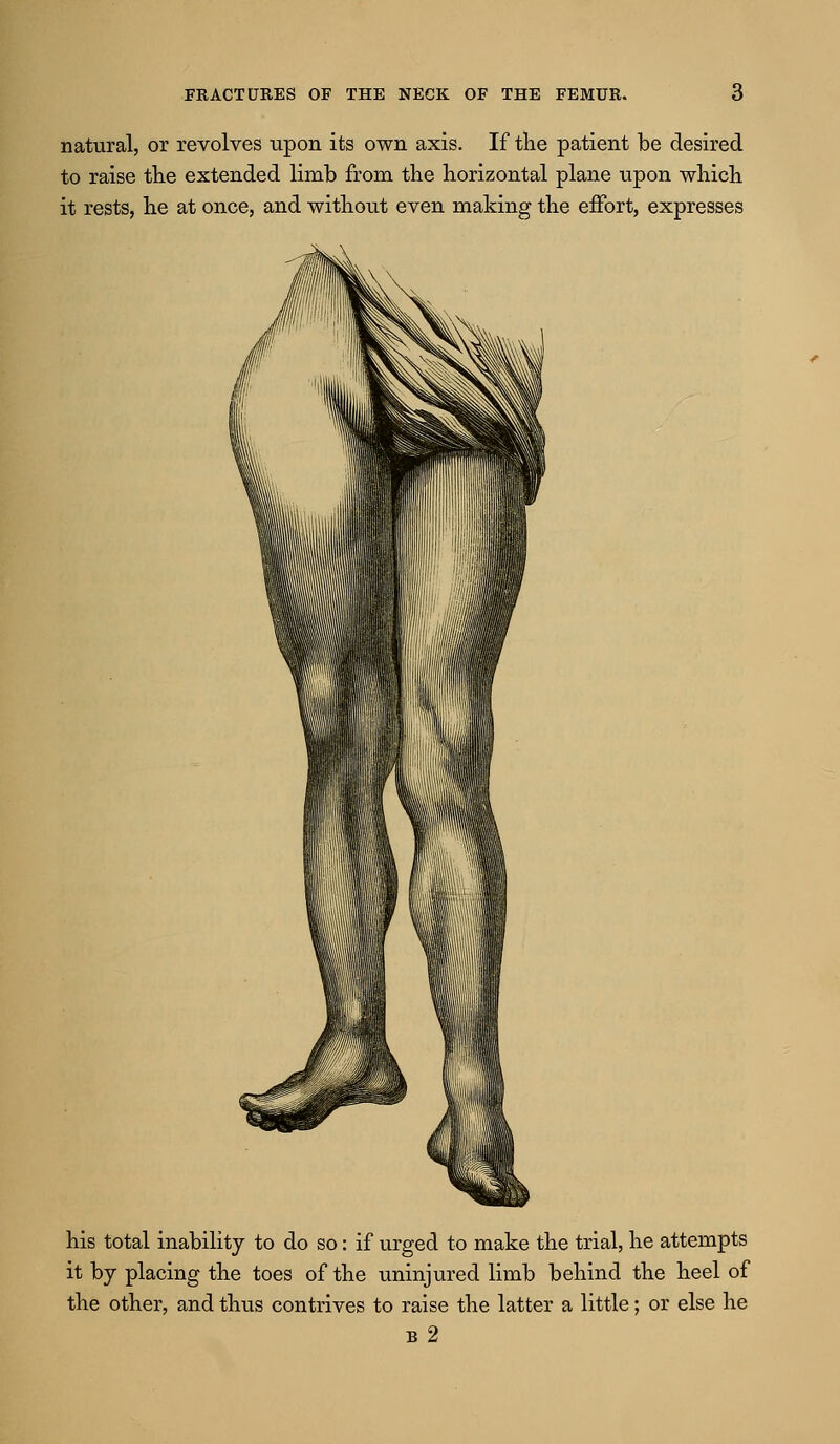 natural, or revolves upon its own axis. If the patient be desired to raise tlie extended limb from the horizontal plane upon which it rests, he at once, and without even making the effort, expresses his total inability to do so: if urged to make the trial, he attempts it by placing the toes of the uninjured limb behind the heel of the other, and thus contrives to raise the latter a little; or else he