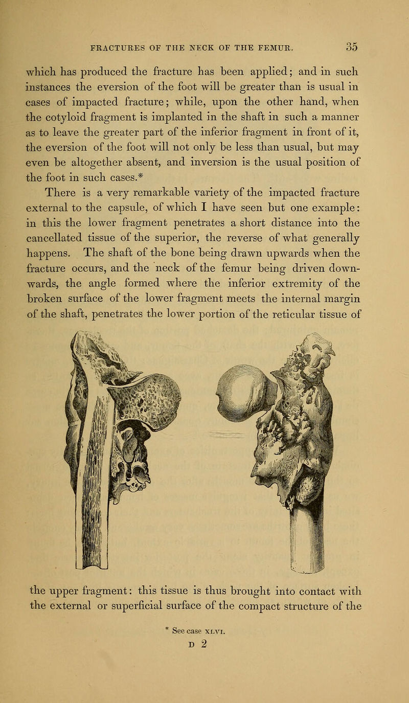 which has produced the fracture has been applied; and in such instances the eversion of the foot will be greater than is usual in cases of impacted fracture; while, upon the other hand, when the cotyloid fragment is implanted in the shaft in such a manner as to leave the greater part of the inferior fragment in front of it, the eversion of the foot will not only be less than usual, but may even be altogether absent, and inversion is the usual position of the foot in such cases.* There is a very remarkable variety of the impacted fracture external to the capsule, of which I have seen but one example: in this the lower fragment penetrates a short distance into the cancellated tissue of the superior, the reverse of what generally happens. The shaft of the bone being drawn upwards when the fracture occurs, and the neck of the femur being driven down- wards, the angle formed where the inferior extremity of the broken surface of the lower fragment meets the internal margin of the shaft, penetrates the lower portion of the reticular tissue of the upper fragment: this tissue is thus brought into contact with the external or superficial surface of the compact structure of the See case xlyi. D 2