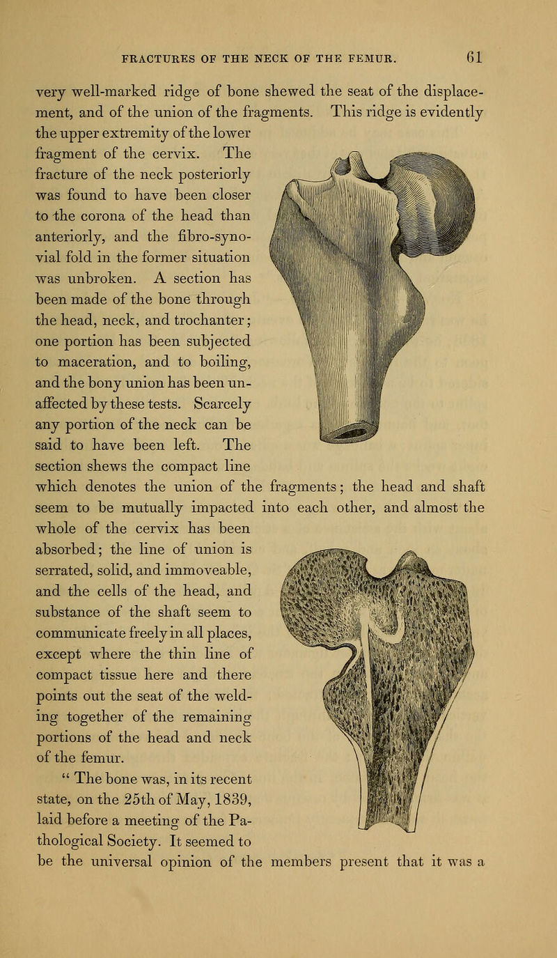 very well-marked ridge of bone shewed tlie seat of tlie displace- ment, and of the union of the fragments. This ridge is evidently the upper extremity of the lower fragment of the cervix. The fracture of the neck posteriorly was found to have been closer to the corona of the head than anteriorly, and the fibro-syno- vial fold in the former situation was unbroken. A section has been made of the bone through the head, neck, and trochanter; one portion has been subjected to maceration, and to boiling, and the bony union has been un- aJEFected by these tests. Scarcely any portion of the neck can be said to have been left. The section shews the compact line which denotes the union of the fragments; the head and shaft seem to be mutually impacted into each other, and almost the whole of the cervix has been absorbed; the line of rinion is serrated, solid, and immoveable, and the cells of the head, and substance of the shaft seem to communicate freely in all places, except where the thin line of compact tissue here and there points out the seat of the weld- ing together of the remaining portions of the head and neck of the femur. The bone was, in its recent state, on the 25th of May, 1839, laid before a meeting of the Pa- thological Society. It seemed to be the universal opinion of the members present that it was a