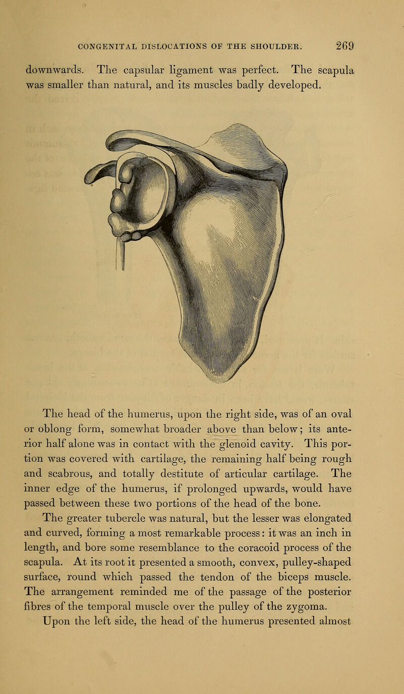 downwards. The capsular ligament was perfect. The scapula was smaller than natural, and its muscles badly developed. The head of the humenis, upon the right side, Avas of an oval or oblong form, somewhat broader above than below; its ante- rior half alone was in contact with the glenoid cavity. This por- tion was covered with cartilage, the remaining half being rough and scabrous, and totally destitute of articular cartilage. The inner edge of the humerus, if prolonged upwards, would have passed between these two portions of the head of the bone. The greater tubercle was natural, but the lesser was elongated and curved, forming a most remarkable process: it was an inch in length, and bore some resemblance to the coracoid process of the scapula. At its root it presented a smooth, convex, pulley-shaped surface, round which passed the tendon of the biceps muscle. The arrangement reminded me of the passage of the posterior fibres of the temporal miiscle over the pulley of the zygoma. Upon the left side, the head of the hviraerus presented almost