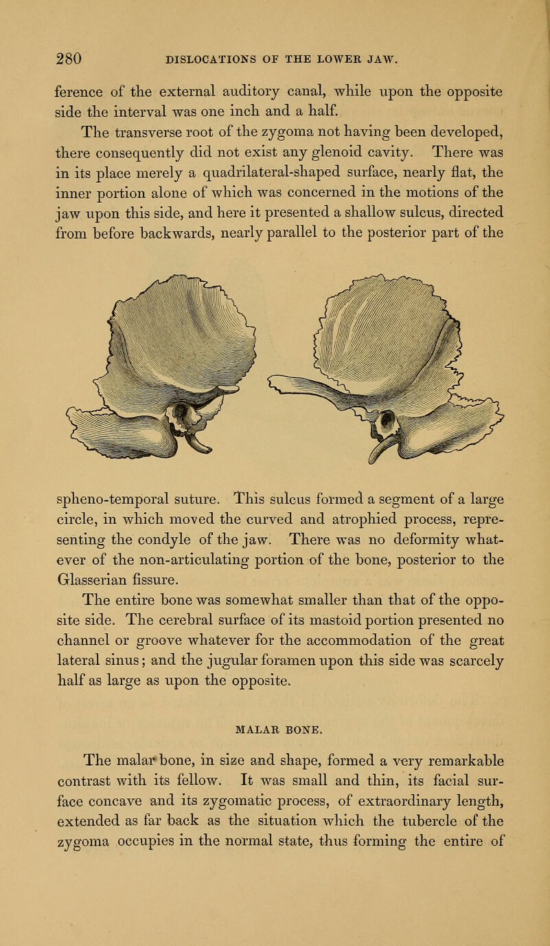 ference of the external auditory canal, while upon the opposite side the interval was one inch and a half. The transverse root of the zygoma not having been developed, there consequently did not exist any glenoid cavity. There was in its place merely a quadrilateral-shaped surface, nearly flat, the inner portion alone of which was concerned in the motions of the jaw upon this side, and here it presented a shallow sulcus, directed from before backwards, nearly parallel to the posterior part of the spheno-temporal suture. This sulcus formed a segment of a large circle, in which moved the curved and atrophied process, repre- senting the condyle of the jaw. There was no deformity what- ever of the non-articulating portion of the bone, posterior to the Glasserian fissure. The entire bone was somewhat smaller than that of the oppo- site side. The cerebral surface of its mastoid portion presented no channel or groove whatever for the accommodation of the great lateral sinus; and the jugular foramen upon this side was scarcely half as large as upon the opposite. MALAR BONE. The malar bone, in size and shape, formed a very remarkable contrast with its fellow. It was small and thin, its facial sur- face concave and its zygomatic process, of extraordinary length, extended as far back as the situation which the tubercle of the zygoma occupies in the normal state, thus forming the entire of