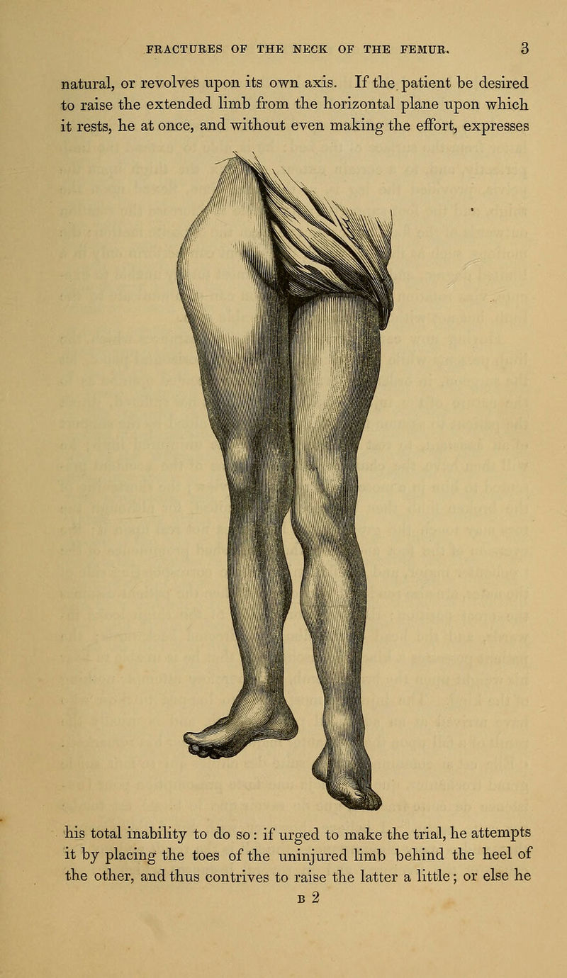 natural, or revolves upon its own axis. If the patient be desired to raise the extended limb from the horizontal plane upon which it rests, he at once, and without even making the effort, expresses his total inability to do so: if urged to make the trial, he attempts it by placing the toes of the uninjured limb behind the heel of the other, and thus contrives to raise the latter a little; or else he