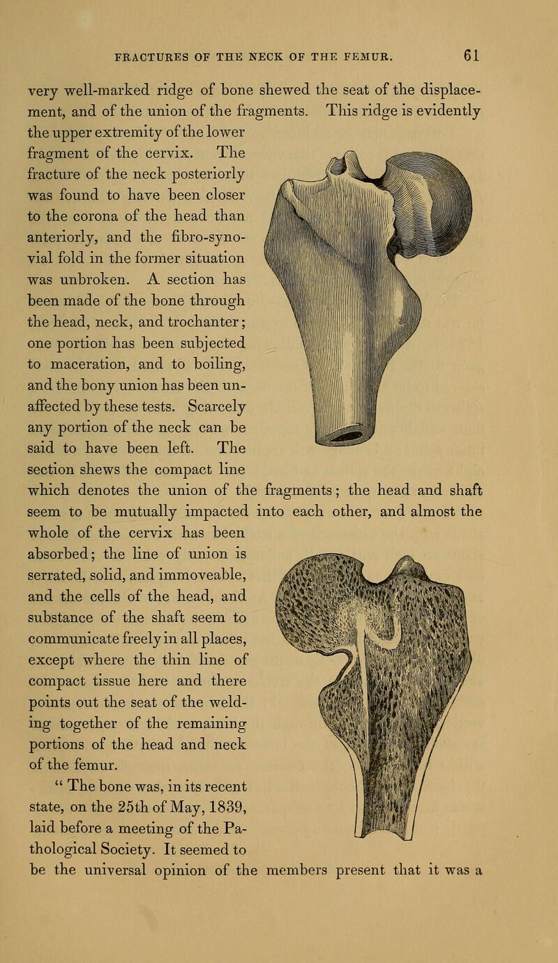 very well-marked ridge of bone shewed the seat of the displace- ment, and of the union of the fragments. This ridge is evidently the upper extremity of the lower fragment of the cervix. The fracture of the neck posteriorly was found to have been closer to the corona of the head than anteriorly, and the fibro-syno- vial fold in the former situation was unbroken. A section has been made of the bone through the head, neck, and trochanter; one portion has been subjected to maceration, and to boiling, and the bony union has been un- affected by these tests. Scarcely any portion of the neck can be said to have been left. The section shews the compact line which denotes the union of the fragments; the head and shaft seem to be mutually impacted into each other, and almost the whole of the cervix has been absorbed; the line of union is serrated, solid, and immoveable, and the cells of the head, and substance of the shaft seem to communicate freely in all places, except where the thin line of compact tissue here and there points out the seat of the weld- ing together of the remaining portions of the head and neck of the femur.  The bone was, in its recent state, on the 25th of May, 1839, laid before a meeting of the Pa- thological Society. It seemed to be the universal opinion of the members present that it was a