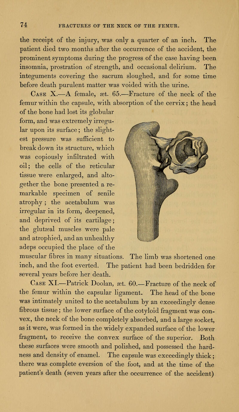 the receipt of the injury, was only a quarter of an inch. The patient died two months after the occurrence of the accident, the prominent symptoms during the progress of the case having been insomnia, prostration of strength, and occasional delirium. The integuments covering the sacrum sloughed, and for some time before death purulent matter was voided with the urine. Case X.—A female, ast. 65.—Fracture of the neck of the femur within the capsule, with absorption of the cervix; the head of the bone had lost its globular form, and was extremely irregu- lar upon its surface; the slight- est pressure was sufficient to break down its structure, which was copiously infiltrated with oil; the cells of the reticular tissue were enlarged, and alto- gether the bone presented a re- markable specimen of senile atrophy; the acetabulum was irregular in its form, deepened, and deprived of its cartilage; the gluteal muscles were pale and atrophied, and an unhealthy adeps occupied the place of the muscular fibres in many situations. The limb was shortened one inch, and the foot everted. The patient had been bedridden for several years before her death. Case XI.—Patrick Doolan, set. 60.—Fracture of the neck of the femur within the capsular ligament. The head of the bone was intimately united to the acetabulum by an exceedingly dense fibrous tissue; the lower surface of the cotyloid fragment was con- vex, the neck of the bone completely absorbed, and a large socket, as it were, was formed in the widely expanded surface of the lower fragment, to receive the convex surface of the superior. Both these surfaces were smooth and polished, and possessed the hard- ness and density of enamel. The capsule was exceedingly thick; there was complete eversion of the foot, and at the time of the patient's death (seven years after the occurrence of the accident)