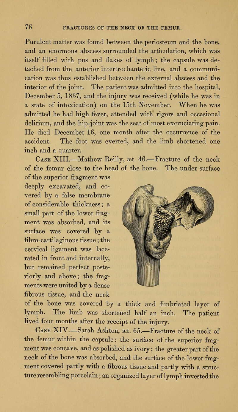 Purulent matter was found between the periosteum and the bone, and an enormous abscess surrounded the articulation, which was itself filled with pus and flakes of lymph; the capsule was de- tached from the anterior intertrochanteric line, and a communi- cation was thus established between the external abscess and the interior of the joint. The patient was admitted into the hospital, December 5, 1837, and the injury was received (while he was in a state of intoxication) on the 15 th November. When he was admitted he had high fever, attended with rigors and occasional delirium, and the hip-joint was the seat of most excruciating pain. He died December 16, one month after the occurrence of the accident. The foot was everted, and the limb shortened one inch and a quarter. Case XIII.—Mathew Reilly, set. 46.—Fracture of the neck of the femur close to the head of the bone. The under surface of the superior fragment was deeply excavated, and co- vered by a false membrane of considerable thickness; a small part of the lower frag- ment was absorbed, and its surface was covered by a fibro-cartilaginous tissue; the cervical ligament was lace- rated in front and internally, but remained perfect poste- riorly and above; the frag- ments were united by a dense fibrous tissue, and the neck of the bone was covered by a thick and fimbriated layer of lymph. The limb was shortened half an inch. The patient lived four months after the receipt of the injury. Case XIV.—Sarah Ashton, get. 65.—Fracture of the neck of the femur within the capsule: the surface of the superior frag- ment was concave, and as polished as ivory; the greater part of the neck of the bone was absorbed, and the surface of the lower frag- ment covered partly with a fibrous tissue and partly with a struc- ture resembling porcelain; an organized layer of lymph invested the