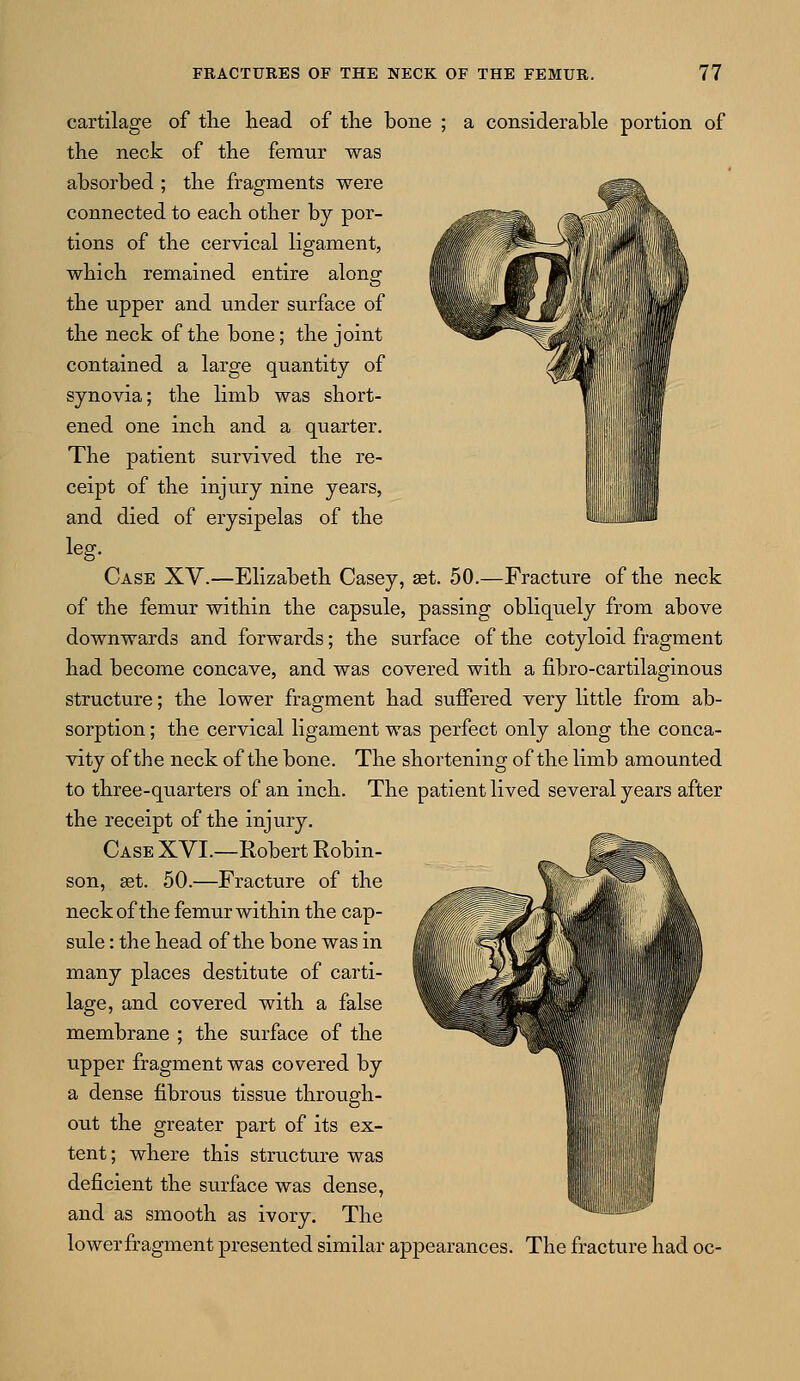 cartilage of the head of the bone ; a considerable portion of the neck of the femur was absorbed ; the fragments were connected to each other by por- tions of the cervical ligament, which remained entire along the upper and under surface of the neck of the bone; the joint contained a large quantity of synovia; the limb was short- ened one inch and a quarter. The patient survived the re- ceipt of the injury nine years, and died of erysipelas of the lilM leg. Case XV.—Elizabeth Casey, ast. 50.—Fracture of the neck of the femur within the capsule, passing obliquely from above downwards and forwards; the surface of the cotyloid fragment had become concave, and was covered with a fibro-cartilaginous structure; the lower fragment had suffered very little from ab- sorption ; the cervical ligament was perfect only along the conca- vity of the neck of the bone. The shortening of the limb amounted to three-quarters of an inch. The patient lived several years after the receipt of the injury. Case XVI.—Robert Robin- son, set. 50.—Fracture of the neck of the femur within the cap- sule : the head of the bone was in many places destitute of carti- lage, and covered with a false membrane ; the surface of the upper fragment was covered by a dense fibrous tissue through- out the greater part of its ex- tent ; where this structure was deficient the surface was dense, and as smooth as ivory. The lowerfragment presented similar appearances. The fracture had oc-