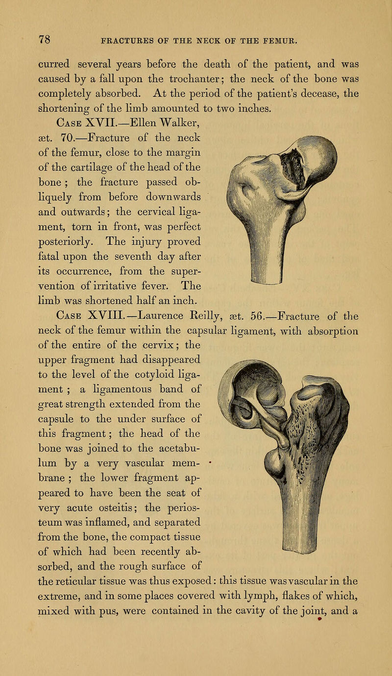 curred several years before the death of the patient, and was caused by a fall upon the trochanter; the neck of the bone was completely absorbed. At the period of the patient's decease, the shortening of the limb amounted to two inches. Case XVII.—Ellen Walker, set. 70.—Fracture of the neck of the femur, close to the margin of the cartilage of the head of the bone; the fracture passed ob- liquely from before downwards and outwards; the cervical liga- ment, torn in front, was perfect posteriorly. The injury proved fatal upon the seventh day after its occurrence, from the super- vention of irritative fever. The limb was shortened half an inch. Case XVIII.—Laurence Reilly, set. 56.—Fracture of the neck of the femur within the capsular ligament, with absorption of the entire of the cervix; the upper fragment had disappeared to the level of the cotyloid liga- ment ; a ligamentous band of great strength extended from the capsule to the under surface of this fragment; the head of the bone was joined to the acetabu- lum by a very vascular mem- brane ; the lower fragment ap- peared to have been the seat of very acute osteitis; the perios- teum was inflamed, and separated from the bone, the compact tissue of which had been recently ab- sorbed, and the rough surface of the reticular tissue was thus exposed: this tissue was vascular in the extreme, and in some places covered with lymph, flakes of which, mixed with pus, were contained in the cavity of the joint, and a