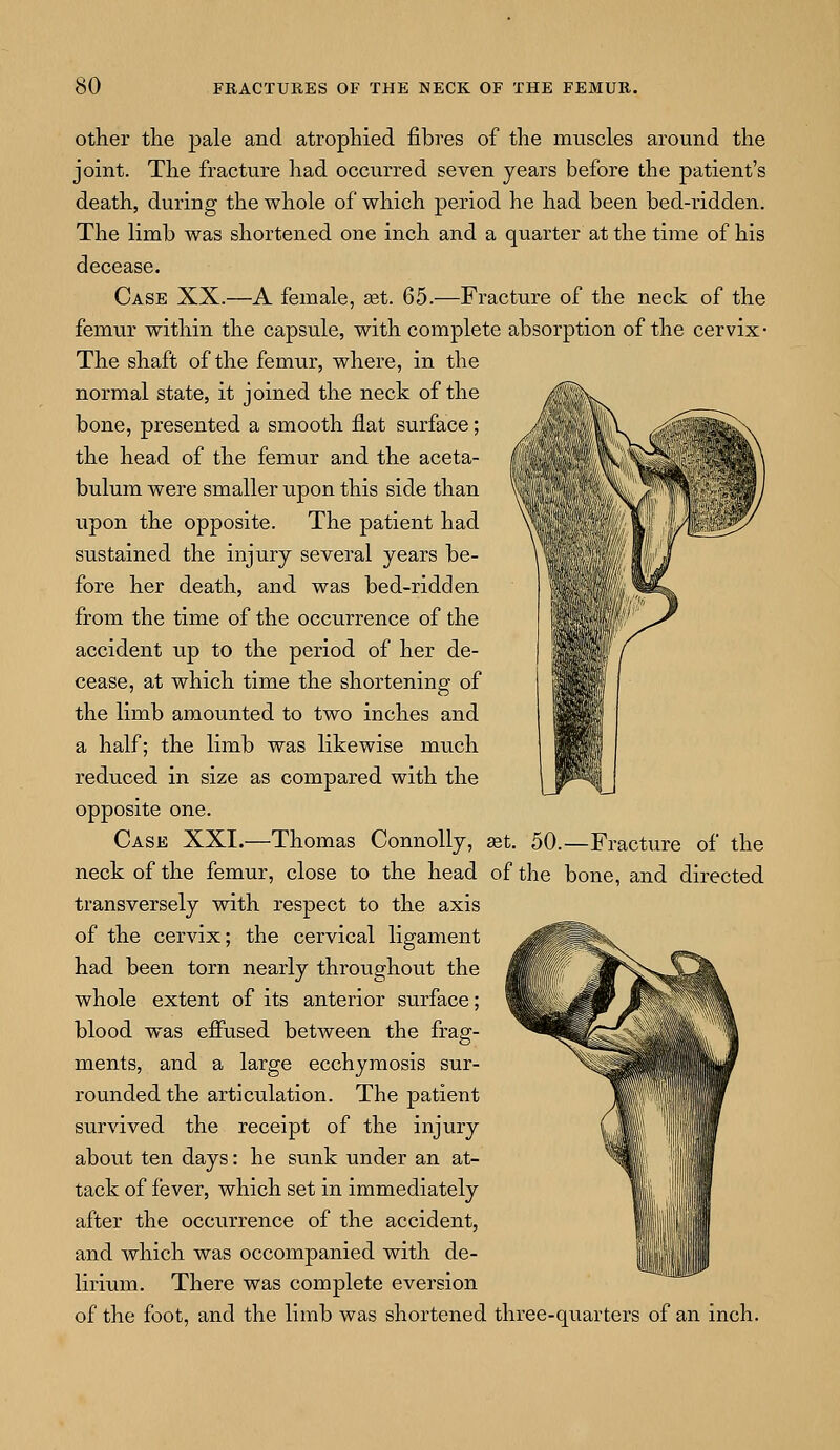 Jm wMSsSKlBSum | 'I, ' other the pale and atrophied fibres of the muscles around the joint. The fracture had occurred seven years before the patient's death, during the whole of which period he had been bed-ridden. The limb was shortened one inch and a quarter at the time of his decease. Case XX.—A female, a?t. 65.—Fracture of the neck of the femur within the capsule, with complete absorption of the cervix- The shaft of the femur, where, in the normal state, it joined the neck of the bone, presented a smooth flat surface; the head of the femur and the aceta- bulum were smaller upon this side than upon the opposite. The patient had sustained the injury several years be- fore her death, and was bed-ridden from the time of the occurrence of the accident up to the period of her de- cease, at which time the shortening of the limb amounted to two inches and a half; the limb was likewise much reduced in size as compared with the opposite one. Case XXI.—Thomas Connolly, aet. 50.—Fracture of the neck of the femur, close to the head of the bone, and directed transversely with respect to the axis of the cervix; the cervical ligament had been torn nearly throughout the whole extent of its anterior surface; blood was effused between the frag- ments, and a large ecchymosis sur- rounded the articulation. The patient survived the receipt of the injury about ten days: he sunk under an at- tack of fever, which set in immediately after the occurrence of the accident, and which was occompanied with de- lirium. There was complete eversion of the foot, and the limb was shortened three-quarters of an inch.