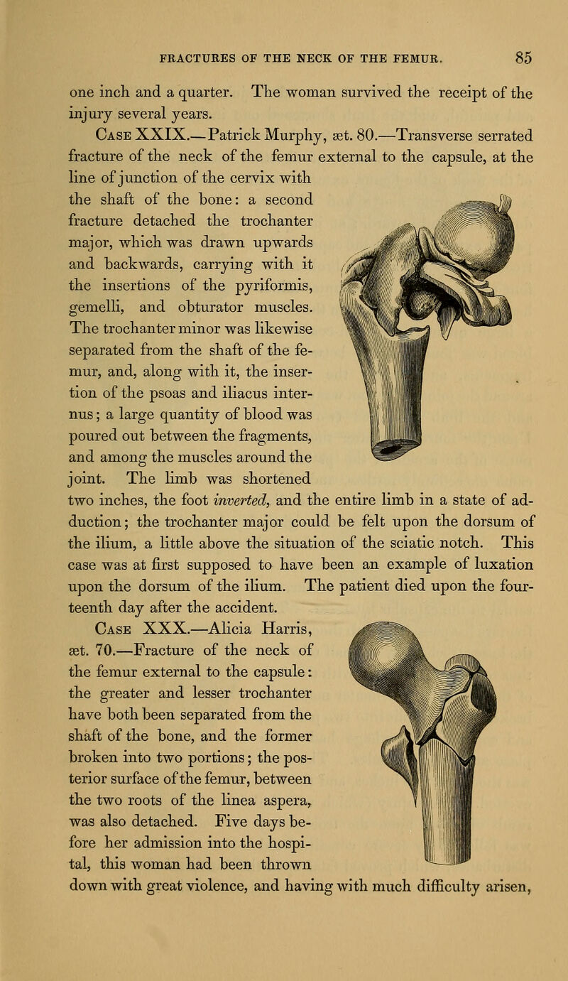 one inch and a quarter. The woman survived the receipt of the injury several years. Case XXIX.—Patrick Murphy, ast. 80.—Transverse serrated fracture of the neck of the femur external to the capsule, at the line of junction of the cervix with the shaft of the bone: a second fracture detached the trochanter major, which was drawn upwards and backwards, carrying with it the insertions of the pyriformis, gemelli, and obturator muscles. The trochanter minor was likewise separated from the shaft of the fe- mur, and, along with it, the inser- tion of the psoas and iliacus inter- nus; a large quantity of blood was poured out between the fragments, and among the muscles around the joint. The limb was shortened two inches, the foot inverted, and the entire limb in a state of ad- duction; the trochanter major could be felt upon the dorsum of the ilium, a little above the situation of the sciatic notch. This case was at first supposed to have been an example of luxation upon the dorsum of the ilium. The patient died upon the four- teenth day after the accident. Case XXX.—Alicia Harris, set. 70.—Fracture of the neck of the femur external to the capsule: the greater and lesser trochanter have both been separated from the shaft of the bone, and the former broken into two portions; the pos- terior surface of the femur, between the two roots of the linea aspera, was also detached. Five days be- fore her admission into the hospi- tal, this woman had been thrown down with great violence, and having with much difficulty arisen,