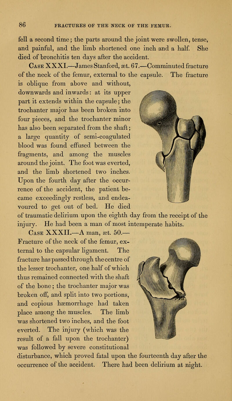 fell a second time; the parts around the joint were swollen, tense, and painful, and the limb shortened one inch and a half. She died of bronchitis ten days after the accident. Case XXXI.—James Stanford, set. 67.—Comminuted fracture of the neck of the femur, external to the capsule. The fracture is oblique from above and without, downwards and inwards: at its upper part it extends within the capsule; the trochanter major has been broken into four pieces, and the trochanter minor has also been separated from the shaft; a large quantity of semi-coagulated blood was found effused between the fragments, and among the muscles around the joint. The foot was everted, and the limb shortened two inches. Upon the fourth day after the occur- rence of the accident, the patient be- came exceedingly restless, and endea- voured to get out of bed. He died of traumatic delirium upon the eighth day from the receipt of the injury. He had been a man of most intemperate habits. Case XXXII.—A man, set. 50.— Fracture of the neck of the femur, ex- ternal to the capsular ligament. The fracture has passed through the centre of the lesser trochanter, one half of which thus remained connected with the shaft of the bone; the trochanter major was broken off, and split into two portions, and copious haemorrhage had taken place among the muscles. The limb was shortened two inches, and the foot everted. The injury (which was the result of a fall upon the trochanter) was followed by severe constitutional disturbance, which proved fatal upon the fourteenth day after the occurrence of the accident. There had been delirium at night.