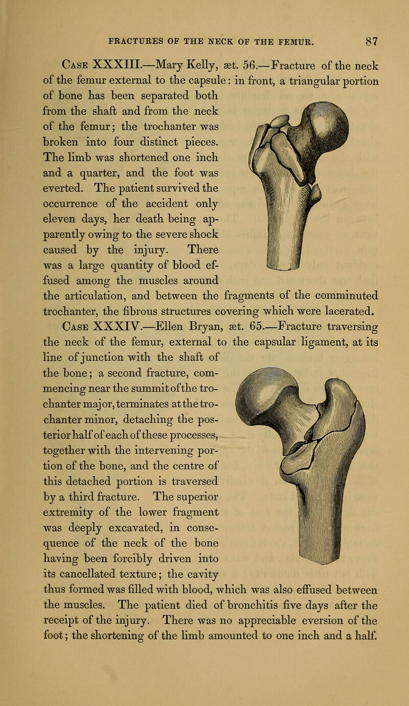 Case XXXIII.—Mary Kelly, jet. 56.—Fracture of the neck of the femur external to the capsule: in front, a triangular portion of bone has been separated both from the shaft and from the neck of the femur; the trochanter was broken into four distinct pieces. The limb was shortened one inch and a quarter, and the foot was everted. The patient survived the occurrence of the accident only eleven days, her death being ap- parently owing to the severe shock caused by the injury. There was a large quantity of blood ef- fused among the muscles around the articulation, and between the fragments of the comminuted trochanter, the fibrous structures covering which were lacerated. Case XXXIV.—Ellen Bryan, at. 65.—Fracture traversing the neck of the femur, external to the capsular ligament, at its line of junction with the shaft of the bone; a second fracture, com- mencing near the summit of the tro- chanter major, terminates at the tro- chanter minor, detaching the pos- terior half of each of these processes, together with the intervening por- tion of the bone, and the centre of this detached portion is traversed by a third fracture. The superior extremity of the lower fragment was deeply excavated, in conse- quence of the neck of the bone having been forcibly driven into its cancellated texture; the cavity thus formed was filled with blood, which was also effused between the muscles. The patient died of bronchitis five days after the receipt of the injury. There was no appreciable eversion of the foot; the shortening of the limb amounted to one inch and a half.