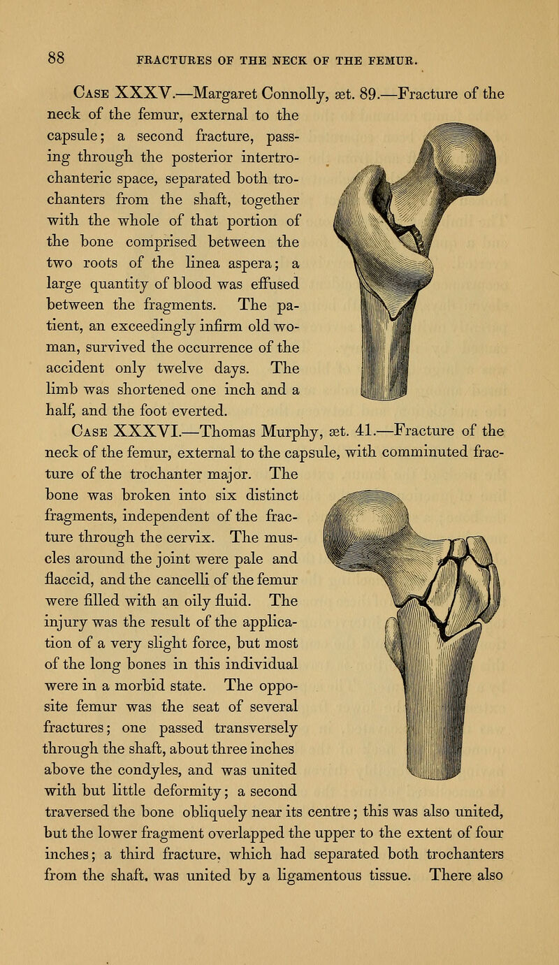 Case XXXV.—Margaret Connolly, set. 89.—Fracture of the neck of the femur, external to the capsule; a second fracture, pass- ing through the posterior intertro- chanteric space, separated both tro- chanters from the shaft, together with the whole of that portion of the hone comprised between the two roots of the linea aspera; a large quantity of blood was effused between the fragments. The pa- tient, an exceedingly infirm old wo- man, survived the occurrence of the accident only twelve days. The limb was shortened one inch and a half, and the foot everted. Case XXXVI.—Thomas Murphy, set. 41.—Fracture of the neck of the femur, external to the capsule, with comminuted frac- ture of the trochanter major. The bone was broken into six distinct fragments, independent of the frac- ture through the cervix. The mus- cles around the joint were pale and flaccid, and the cancelli of the femur were filled with an oily fluid. The injury was the result of the applica- tion of a very slight force, but most of the long bones in this individual were in a morbid state. The oppo- site femur was the seat of several fractures; one passed transversely through the shaft, about three inches above the condyles, and was united with but little deformity; a second traversed the bone obliquely near its centre; this was also united, but the lower fragment overlapped the upper to the extent of four inches; a third fracture, which had separated both trochanters from the shaft, was united by a ligamentous tissue. There also