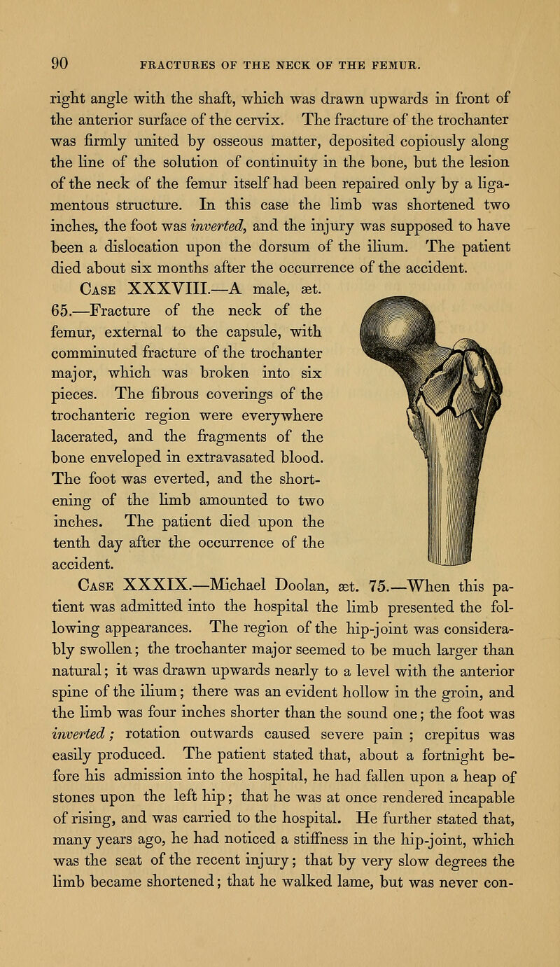 right angle with the shaft, which was drawn upwards in front of the anterior surface of the cervix. The fracture of the trochanter was firmly united by osseous matter, deposited copiously along the line of the solution of continuity in the bone, but the lesion of the neck of the femur itself had been repaired only by a liga- mentous structure. In this case the limb was shortened two inches, the foot was inverted, and the injury was supposed to have been a dislocation upon the dorsum of the ilium. The patient died about six months after the occurrence of the accident. Case XXXVIII.—A male, set. 65.—Fracture of the neck of the femur, external to the capsule, with comminuted fracture of the trochanter major, which was broken into six pieces. The fibrous coverings of the trochanteric region were everywhere lacerated, and the fragments of the bone enveloped in extravasated blood. The foot was everted, and the short- ening of the limb amounted to two inches. The patient died upon the tenth day after the occurrence of the accident. Case XXXIX.—Michael Doolan, ast. 75.—When this pa- tient was admitted into the hospital the limb presented the fol- lowing appearances. The region of the hip-joint was considera- bly swollen; the trochanter major seemed to be much larger than natural; it was drawn upwards nearly to a level with the anterior spine of the ilium; there was an evident hollow in the groin, and the limb was four inches shorter than the soimd one; the foot was inverted; rotation outwards caused severe pain ; crepitus was easily produced. The patient stated that, about a fortnight be- fore his admission into the hospital, he had fallen upon a heap of stones upon the left hip; that he was at once rendered incapable of rising, and was carried to the hospital. He further stated that, many years ago, he had noticed a stiffness in the hip-joint, which was the seat of the recent injury; that by very slow degrees the limb became shortened; that he walked lame, but was never con-