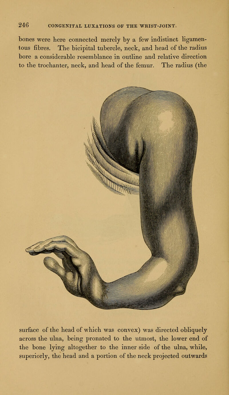 bones were here connected merely by a few indistinct ligamen- tous fibres. The bicipital tubercle, neck, and head of the radius bore a considerable resemblance in outline and relative direction to the trochanter, neck, and head of the femur. The radius (the surface of the head of which was convex) was directed obliquely across the ulna, being pronated to the utmost, the lower end of the bone lying altogether to the inner side of the ulna, while, superiorly, the head and a portion of the neck projected outwards