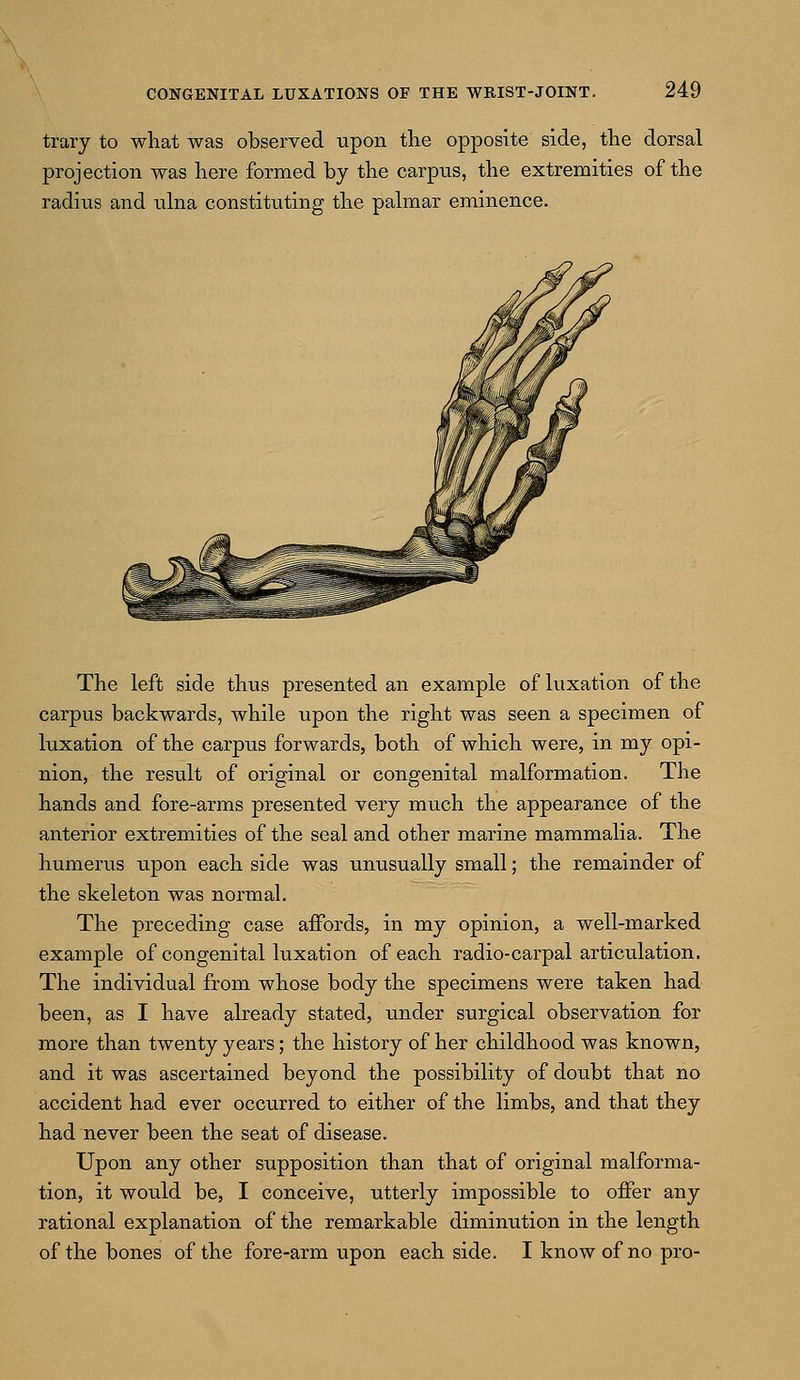 trary to what was observed upon the opposite side, the dorsal projection was here formed by the carpus, the extremities of the radius and ulna constituting the palmar eminence. The left side thus presented an example of luxation of the carpus backwards, while upon the right was seen a specimen of luxation of the carpus forwards, both of which were, in my opi- nion, the result of original or congenital malformation. The hands and fore-arms presented very much the appearance of the anterior extremities of the seal and other marine mammalia. The humerus upon each side was unusually small; the remainder of the skeleton was normal. The preceding case affords, in my opinion, a well-marked example of congenital luxation of each radio-carpal articulation. The individual from whose body the specimens were taken had been, as I have already stated, under surgical observation for more than twenty years; the history of her childhood was known, and it was ascertained beyond the possibility of doubt that no accident had ever occurred to either of the limbs, and that they had never been the seat of disease. Upon any other supposition than that of original malforma- tion, it would be, I conceive, utterly impossible to offer any rational explanation of the remarkable diminution in the length of the bones of the fore-arm upon each side. I know of no pro-