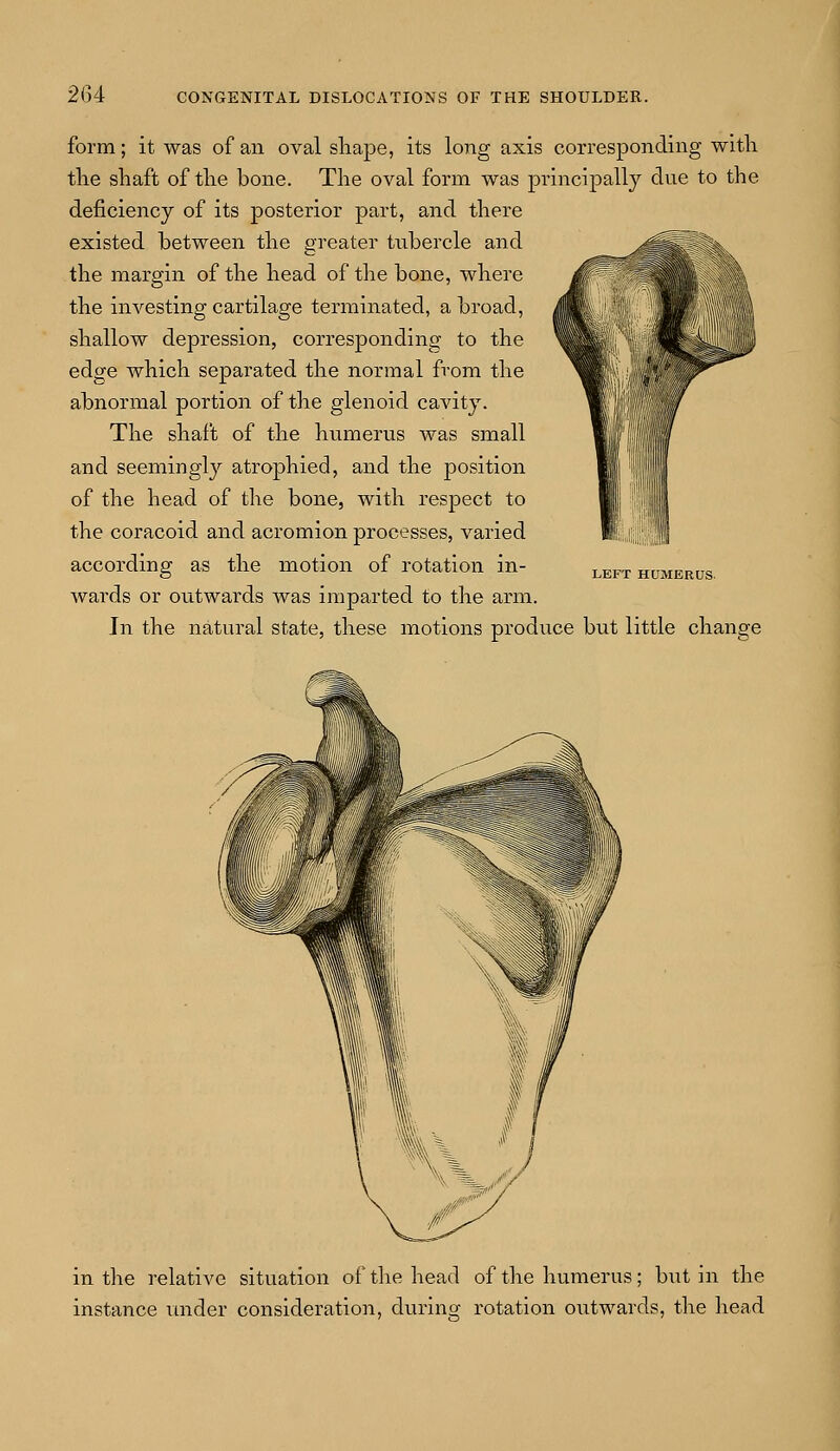 form; it was of an oval shape, its long axis corresponding with the shaft of the bone. The oval form was principally due to the deficiency of its posterior part, and there existed between the greater tubercle and the margin of the head of the bone, where the investing cartilage terminated, a broad, shallow depression, corresponding to the edge which separated the normal from the abnormal portion of the glenoid cavity. The shaft of the humerus was small and seemingly atrophied, and the position of the head of the bone, with respect to the coracoid and acromion processes, varied according as the motion of rotation in- wards or outwards was imparted to the arm. In the natural state, these motions produce but little change LEFT HUMERUS in the relative situation of the head of the humerus; but in the instance under consideration, during rotation outwards, the head