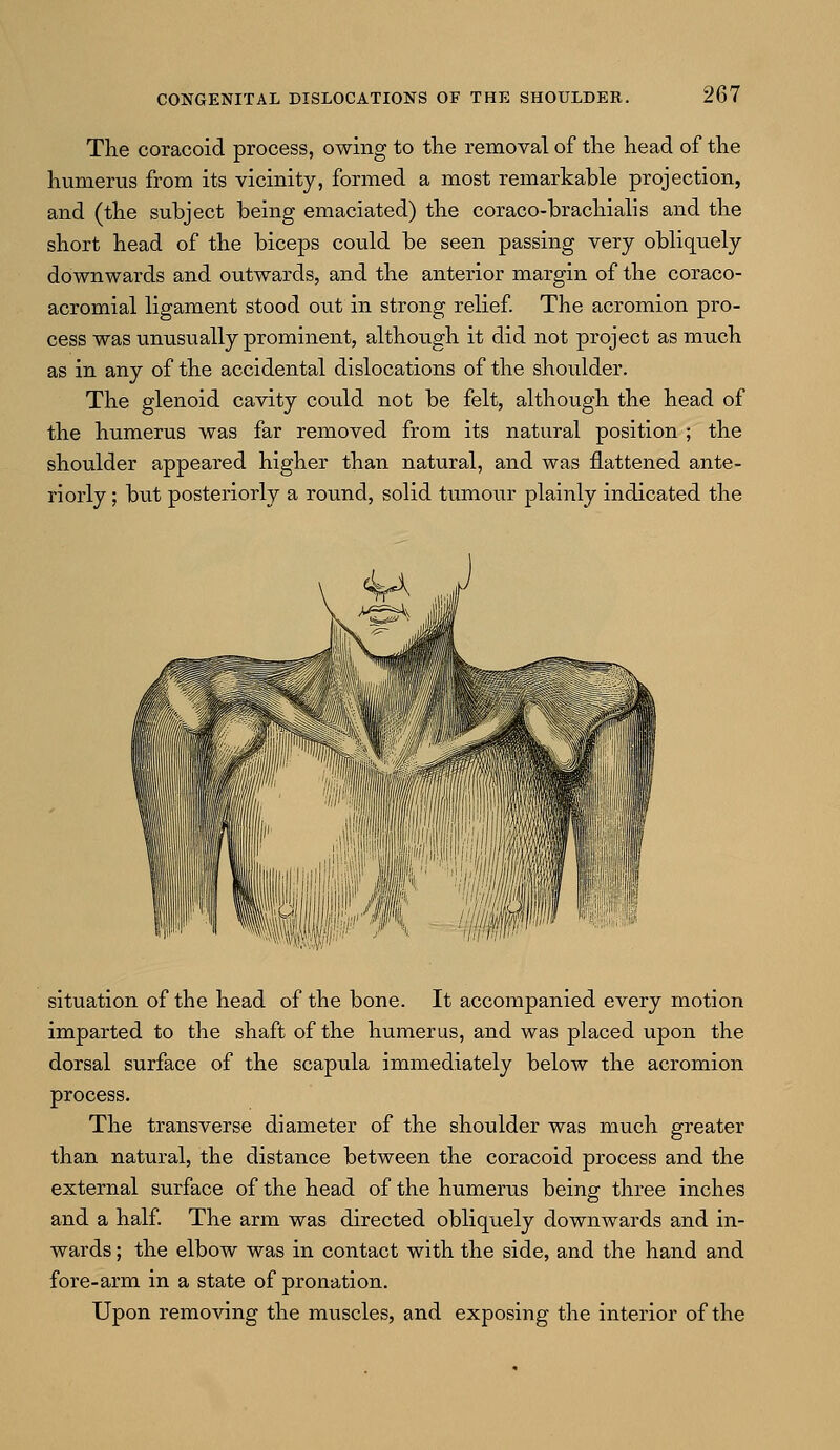 The coracoid process, owing to the removal of the head of the humerus from its vicinity, formed a most remarkable projection, and (the subject being emaciated) the coraco-brachialis and the short head of the biceps could be seen passing very obliquely downwards and outwards, and the anterior margin of the coraco- acromial ligament stood out in strong relief. The acromion pro- cess was unusually prominent, although it did not project as much as in any of the accidental dislocations of the shoulder. The glenoid cavity could not be felt, although the head of the humerus was far removed from its natural position ; the shoulder appeared higher than natural, and was flattened ante- riorly ; but posteriorly a round, solid tumour plainly indicated the situation of the head of the bone. It accompanied every motion imparted to the shaft of the humerus, and was placed upon the dorsal surface of the scapula immediately below the acromion process. The transverse diameter of the shoulder was much greater than natural, the distance between the coracoid process and the external surface of the head of the humerus being three inches and a half. The arm was directed obliquely downwards and in- wards ; the elbow was in contact with the side, and the hand and fore-arm in a state of pronation. Upon removing the muscles, and exposing the interior of the