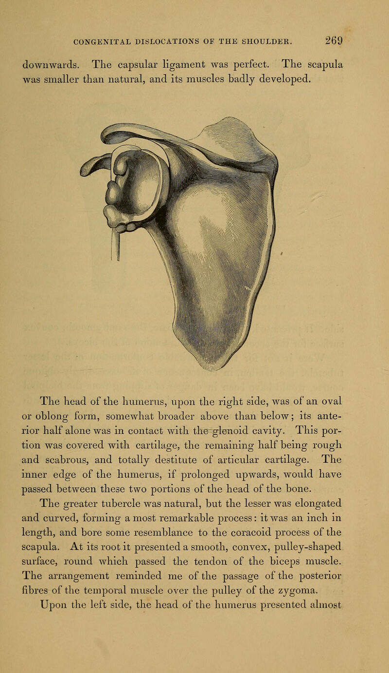 downwards. The capsular ligament was perfect. The scapula was smaller than natural, and its muscles badly developed. The head of the humerus, upon the right side, was of an oval or oblong form, somewhat broader above than below; its ante- rior half alone was in contact with the glenoid cavity. This por- tion was covered with cartilage, the remaining half being rough and scabrous, and totally destitute of articular cartilage. The inner edge of the humerus, if prolonged upwards, would have passed between these two portions of the head of the bone. The greater tubercle was natural, but the lesser was elongated and curved, forming a most remarkable process: it was an inch in length, and bore some resemblance to the coracoid process of the scapula. At its root it presented a smooth, convex, pulley-shaped surface, round which passed the tendon of the biceps muscle. The arrangement reminded me of the passage of the posterior fibres of the temporal muscle over the pulley of the zygoma. Upon the left side, the head of the humerus presented almost