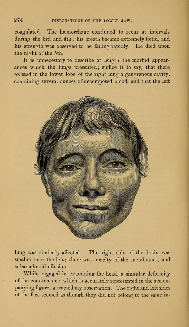 coagulated. The haemorrhage continued to recur at intervals during the 3rd and 4th; his breath became extremely foetid, and his strength was observed to be failing rapidly. He died upon the night of the 5th. It is unnecessary to describe at length the morbid appear- ances which the lungs presented; suffice it to say, that there existed in the lower lobe of the right lung a gangrenous cavity, containing several ounces of decomposed blood, and that the left lung was similarly affected. The right side of the brain was smaller than the left; there was opacity of the membranes, and subarachnoid effusion. While engaged in examining the head, a singular deformity of the countenance, which is accurately represented in the accom- panying figure, attracted my observation. The right and left sides of the face seemed as though they did not belong to the same in-