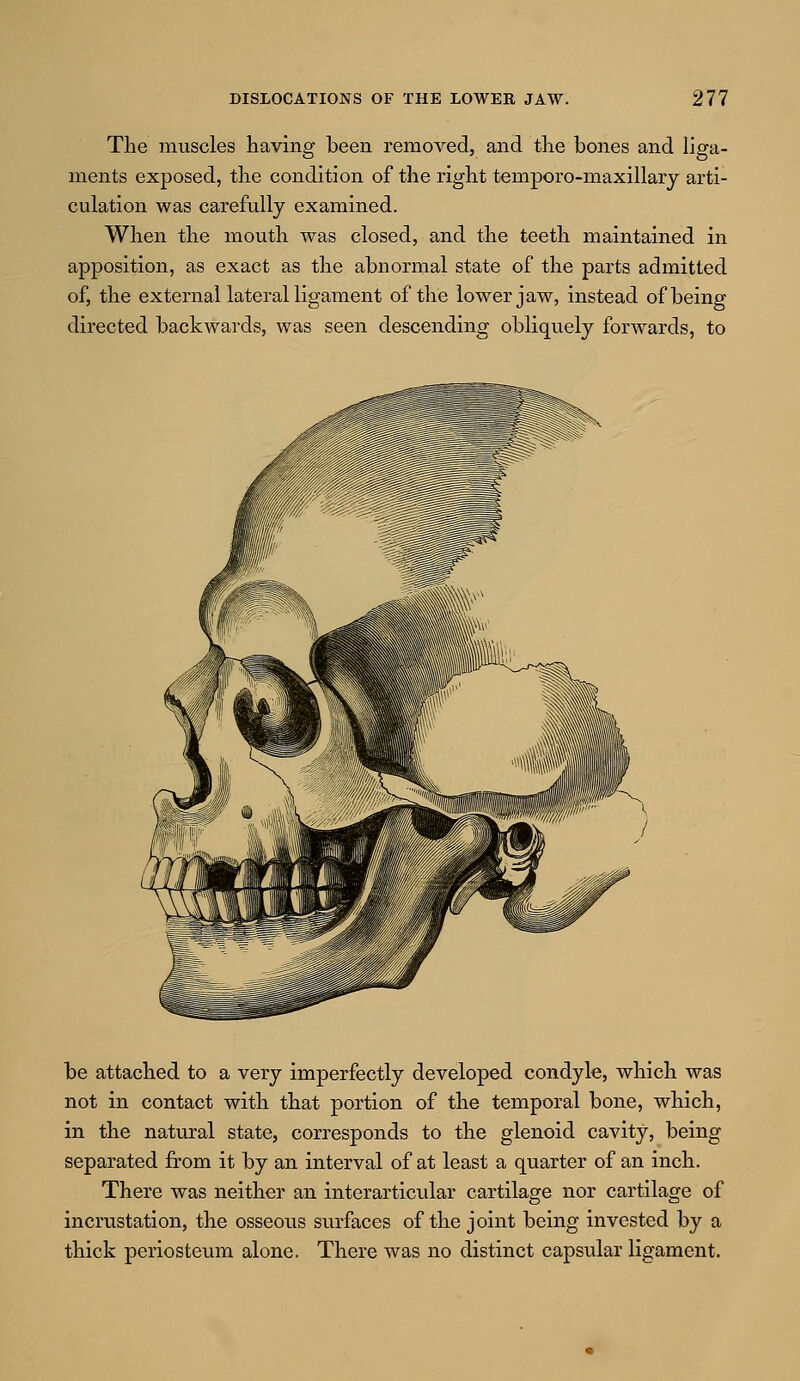 The muscles having been removed, and the bones and liga- ments exposed, the condition of the right temporo-maxillary arti- culation was carefully examined. When the mouth was closed, and the teeth maintained in apposition, as exact as the abnormal state of the parts admitted of, the external lateral ligament of the lower jaw, instead of being directed backwards, was seen descending obliquely forwards, to be attached to a very imperfectly developed condyle, which was not in contact with that portion of the temporal bone, which, in the natural state, corresponds to the glenoid cavity, being- separated from it by an interval of at least a quarter of an inch. There was neither an interarticular cartilage nor cartilage of incrustation, the osseous surfaces of the joint being invested by a thick periosteum alone. There was no distinct capsular ligament.
