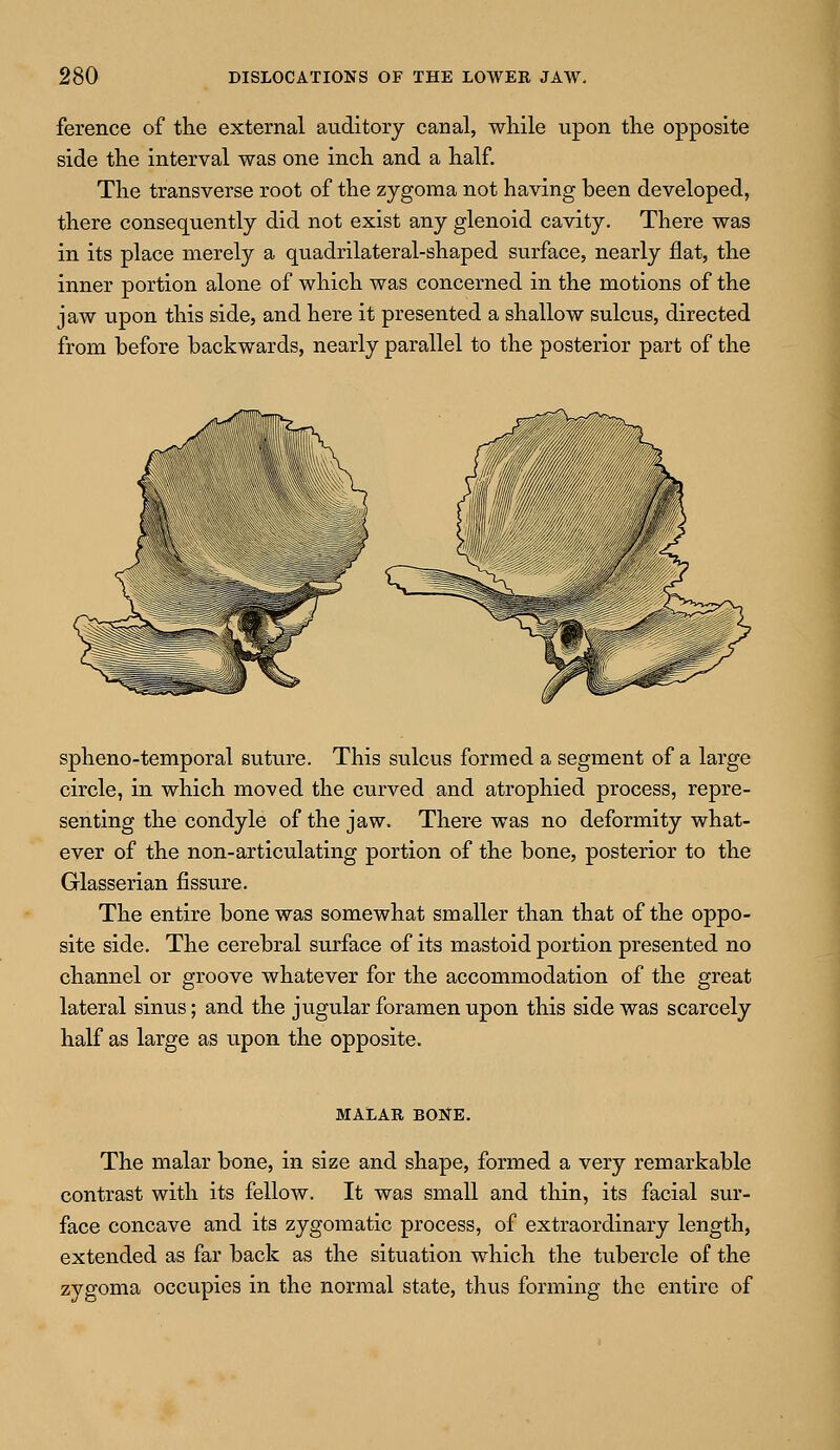 ference of the external auditory canal, while upon the opposite side the interval was one inch and a half. The transverse root of the zygoma not having been developed, there consequently did not exist any glenoid cavity. There was in its place merely a quadrilateral-shaped surface, nearly flat, the inner portion alone of which was concerned in the motions of the jaw upon this side, and here it presented a shallow sulcus, directed from before backwards, nearly parallel to the posterior part of the spheno-temporal suture. This sulcus formed a segment of a large circle, in which moved the curved and atrophied process, repre- senting the condyle of the jaw. There was no deformity what- ever of the non-articulating portion of the bone, posterior to the Glasserian fissure. The entire bone was somewhat smaller than that of the oppo- site side. The cerebral surface of its mastoid portion presented no channel or groove whatever for the accommodation of the great lateral sinus; and the jugular foramen upon this side was scarcely half as large as upon the opposite. MALAR BONE. The malar bone, in size and shape, formed a very remarkable contrast with its fellow. It was small and thin, its facial sur- face concave and its zygomatic process, of extraordinary length, extended as far back as the situation which the tubercle of the zygoma occupies in the normal state, thus forming the entire of